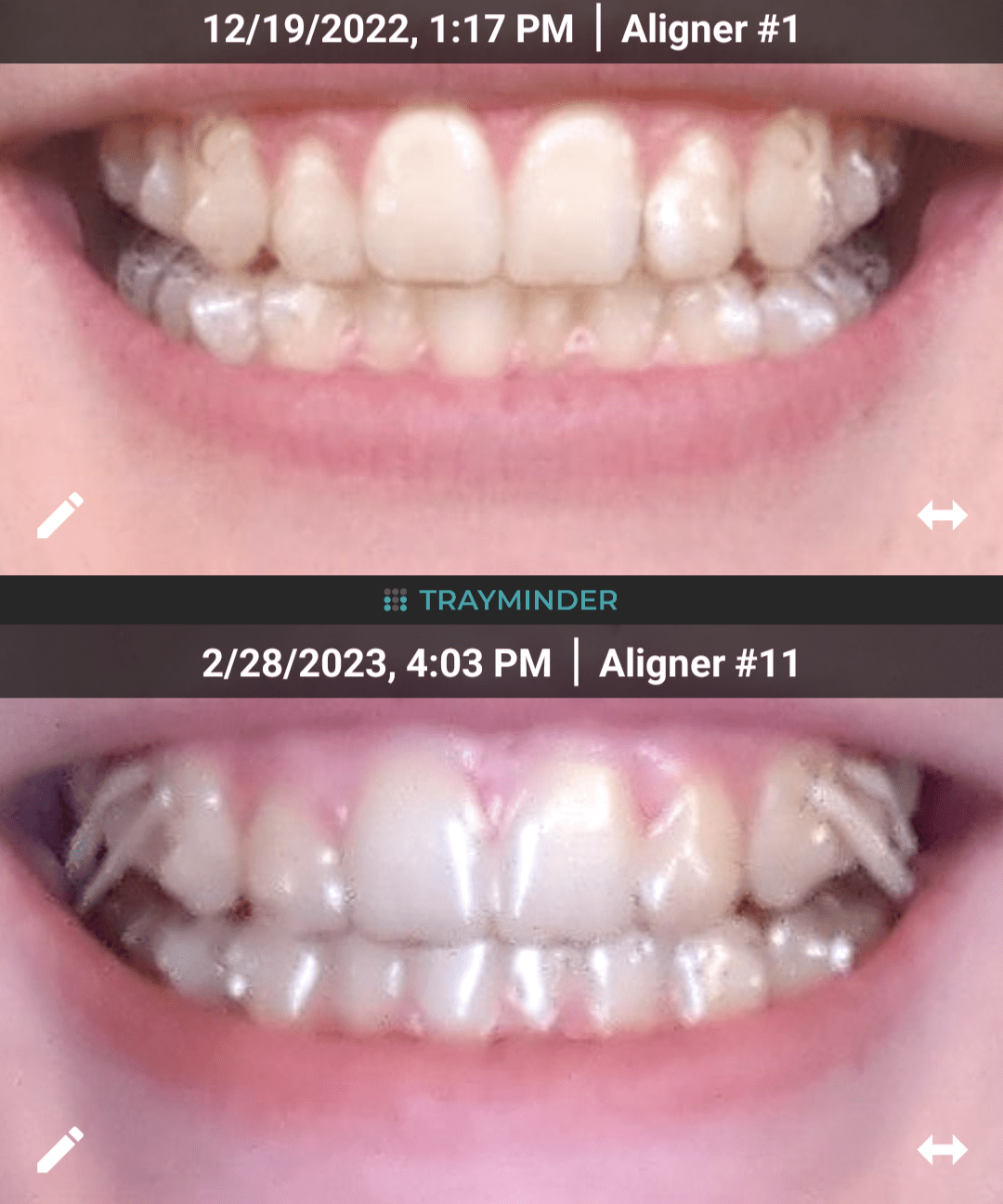 Halfway done with my first set of aligners (11/23)! I can't see much of