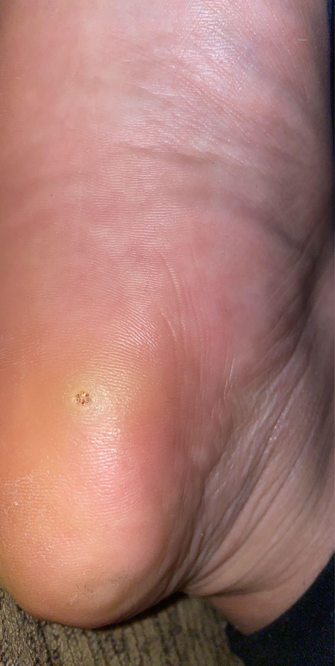 Plantar wart won’t go away r/popping