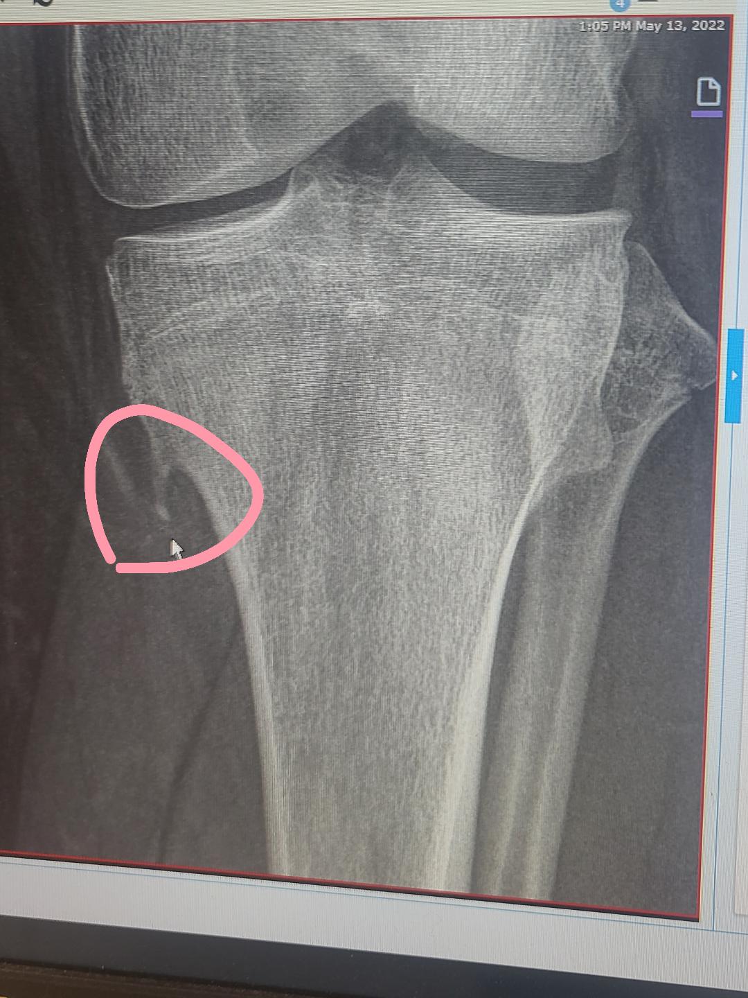 I have a defect that causes a piece of bone to grow out of my