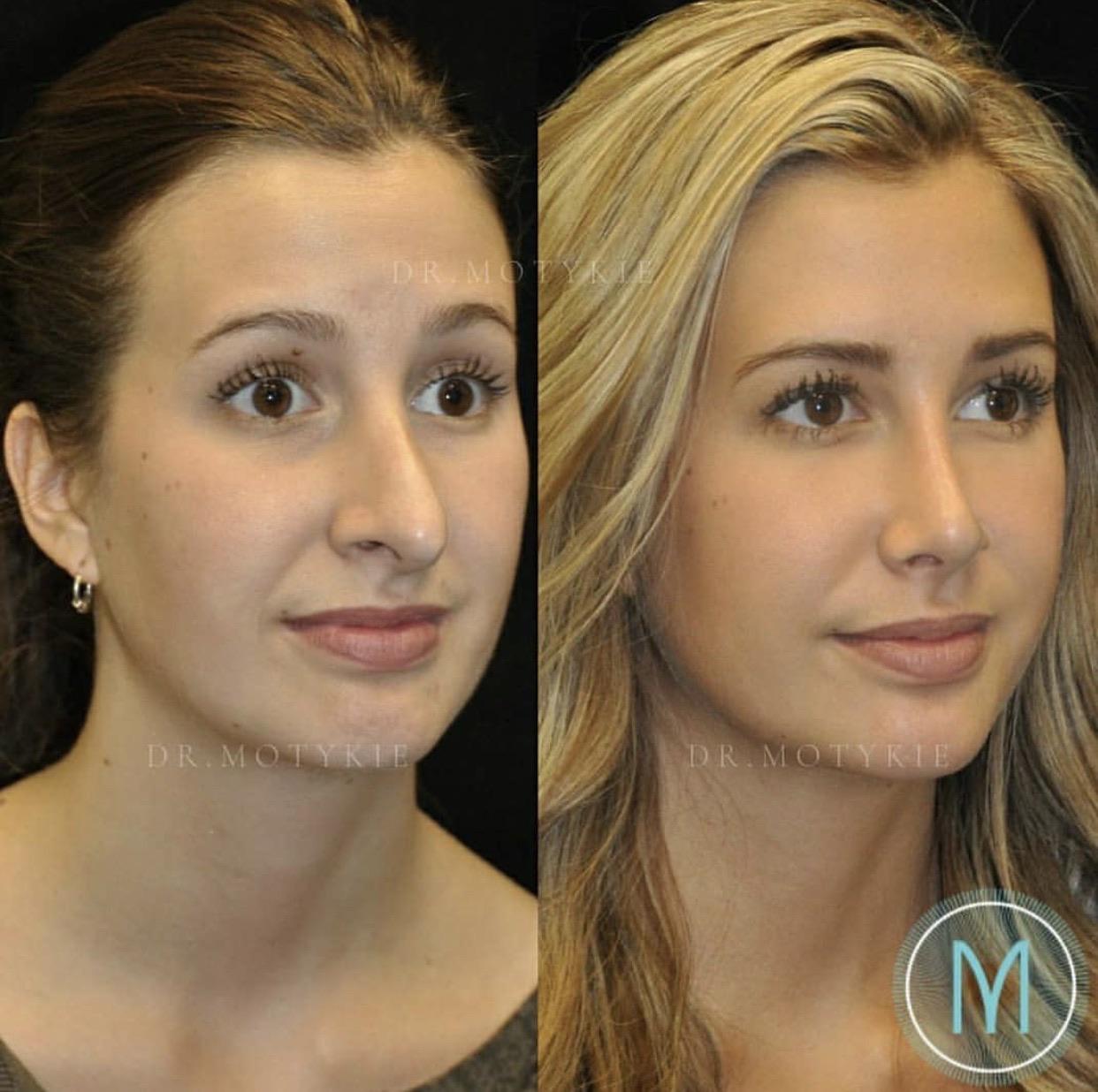 Came across this amazing before and after! (rhinoplasty) r/Vindicta