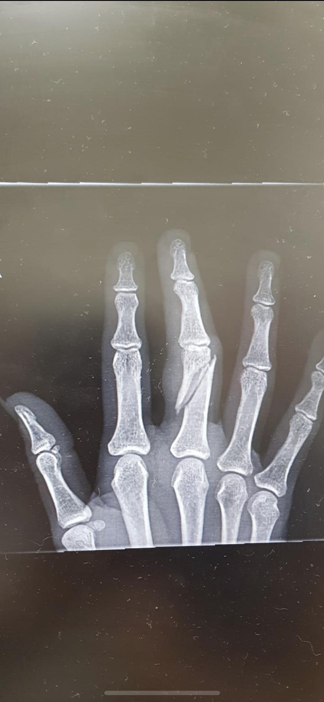 Broken finger after getting caught in my dogs leash r/XRayPorn
