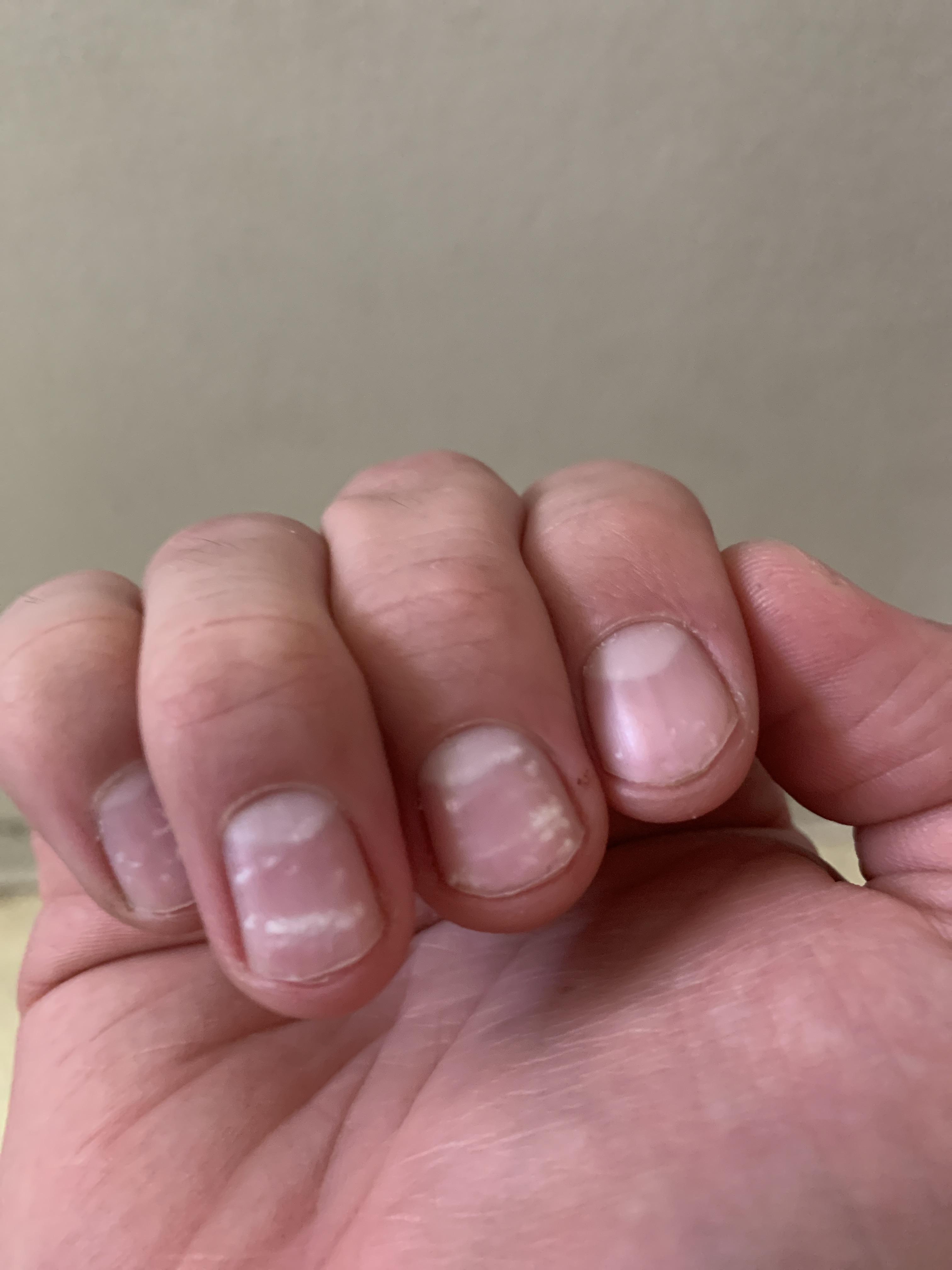 White On Fingernails Deficiency