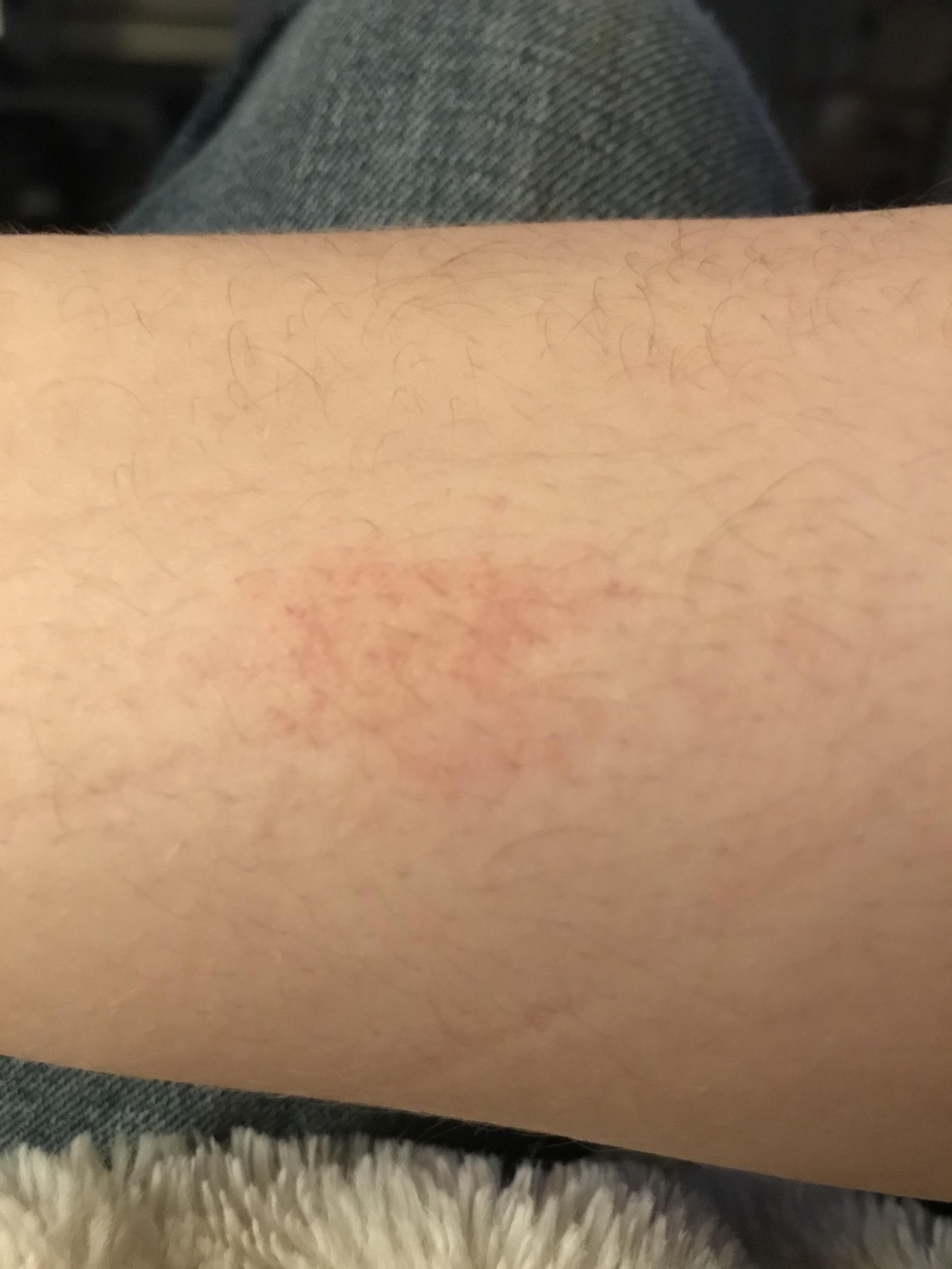 16 FTMPRET neurological issues and rash r/medical_advice