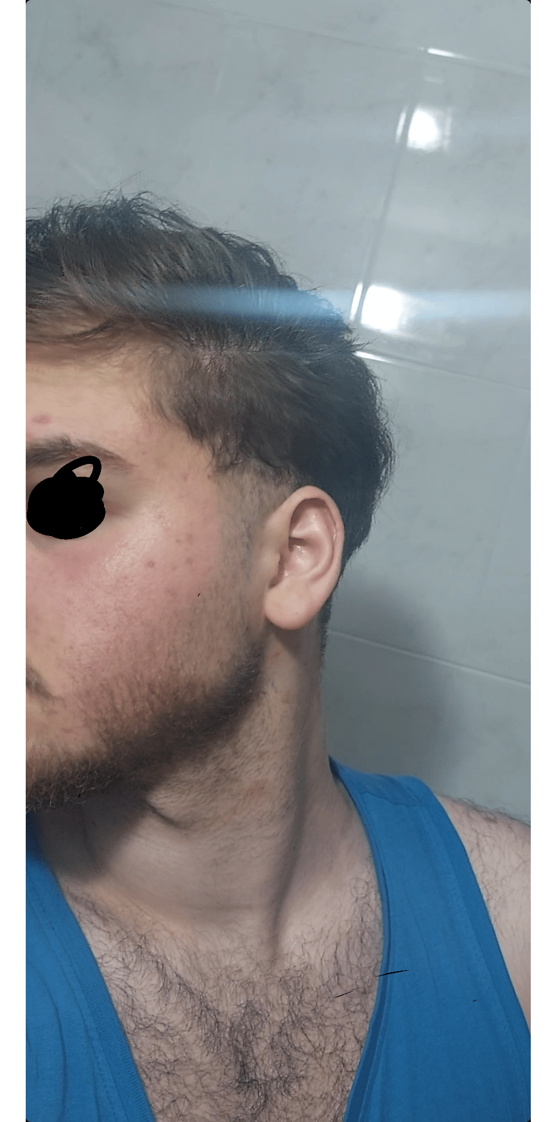 Red face r/Rosacea