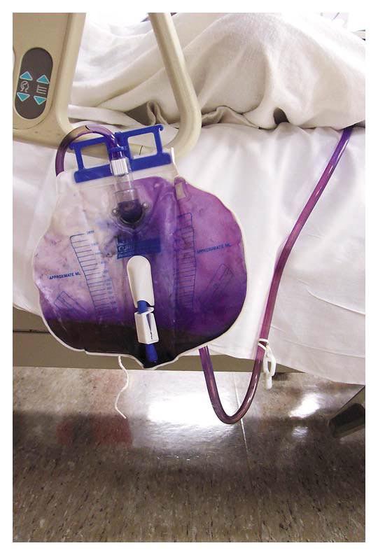 Purple pee purple bag syndrome is when a UTI and catheter arrangement
