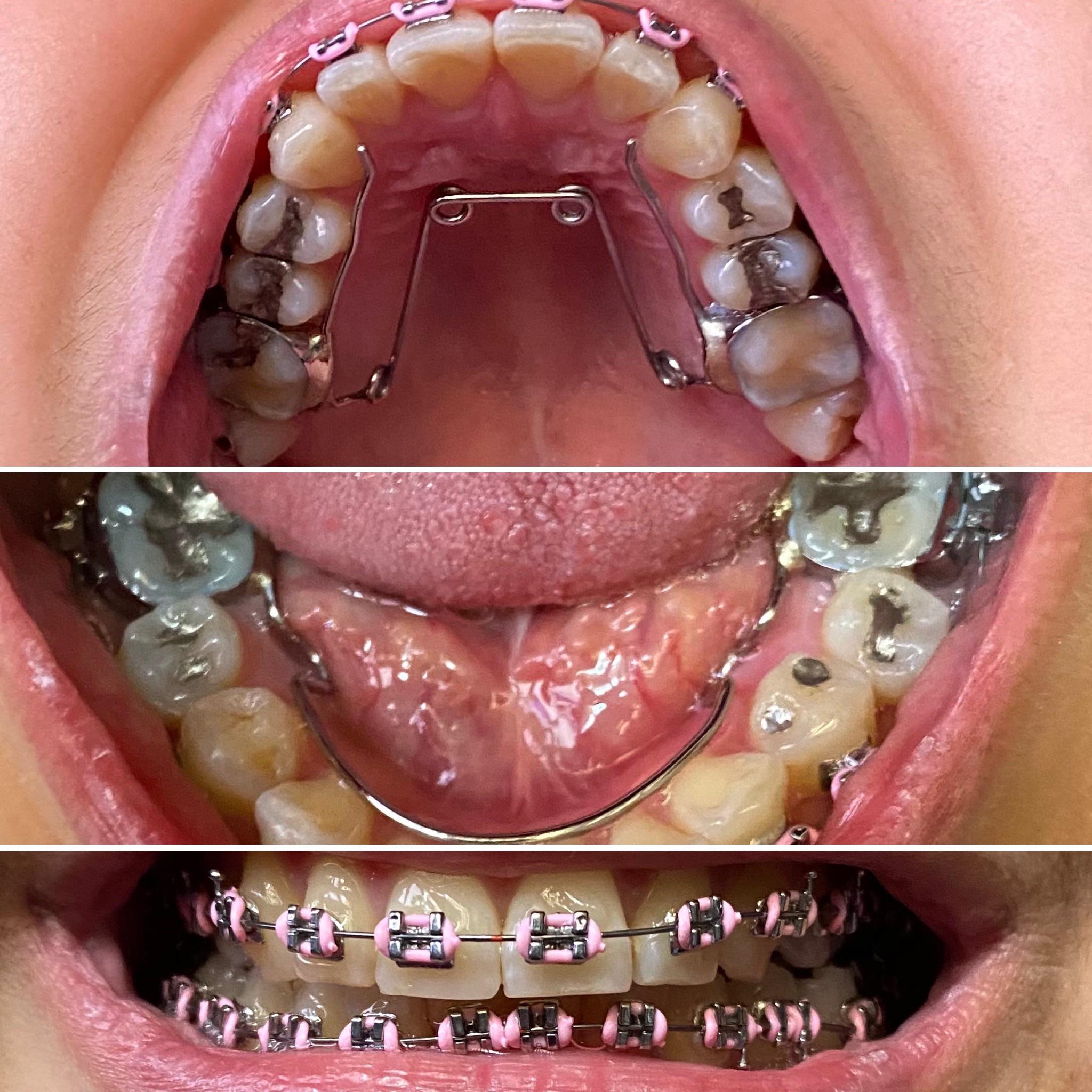 7 weeks Quad Helix and Lower Lingual Arch r/braces