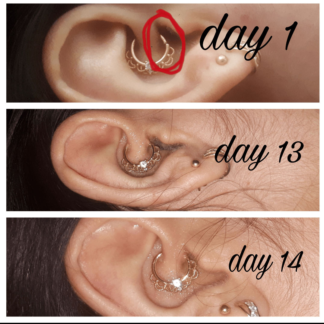 I think the end of my jewellery causes irritation in my ear , am i