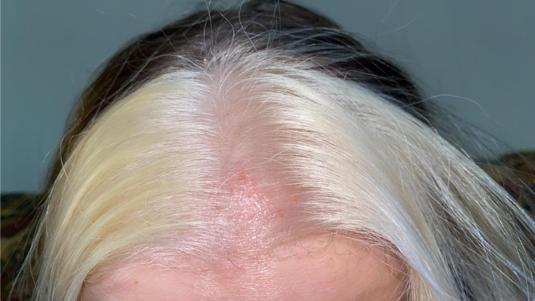 Bleach Chemical Burn