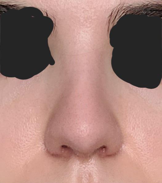 2.5 months postop rhinoplasty, crooked/uneven nose or simply swelling