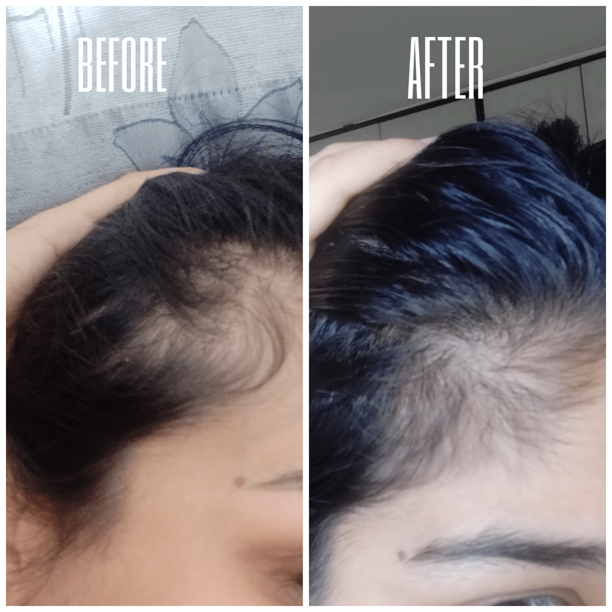 Minoxidil 3 month progress r/FemaleHairLoss