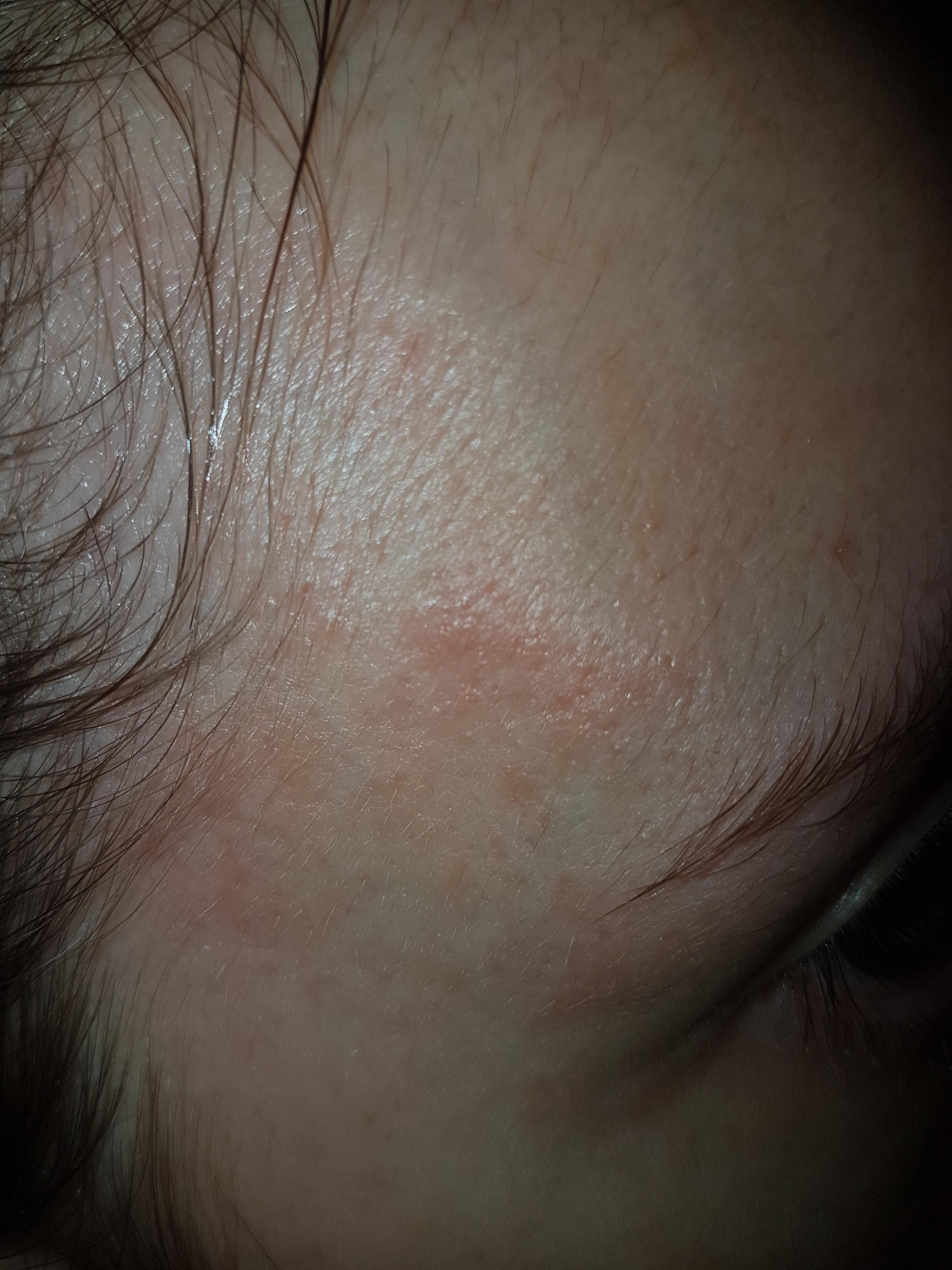 Accutane rashes / eczema on face? r/Accutane