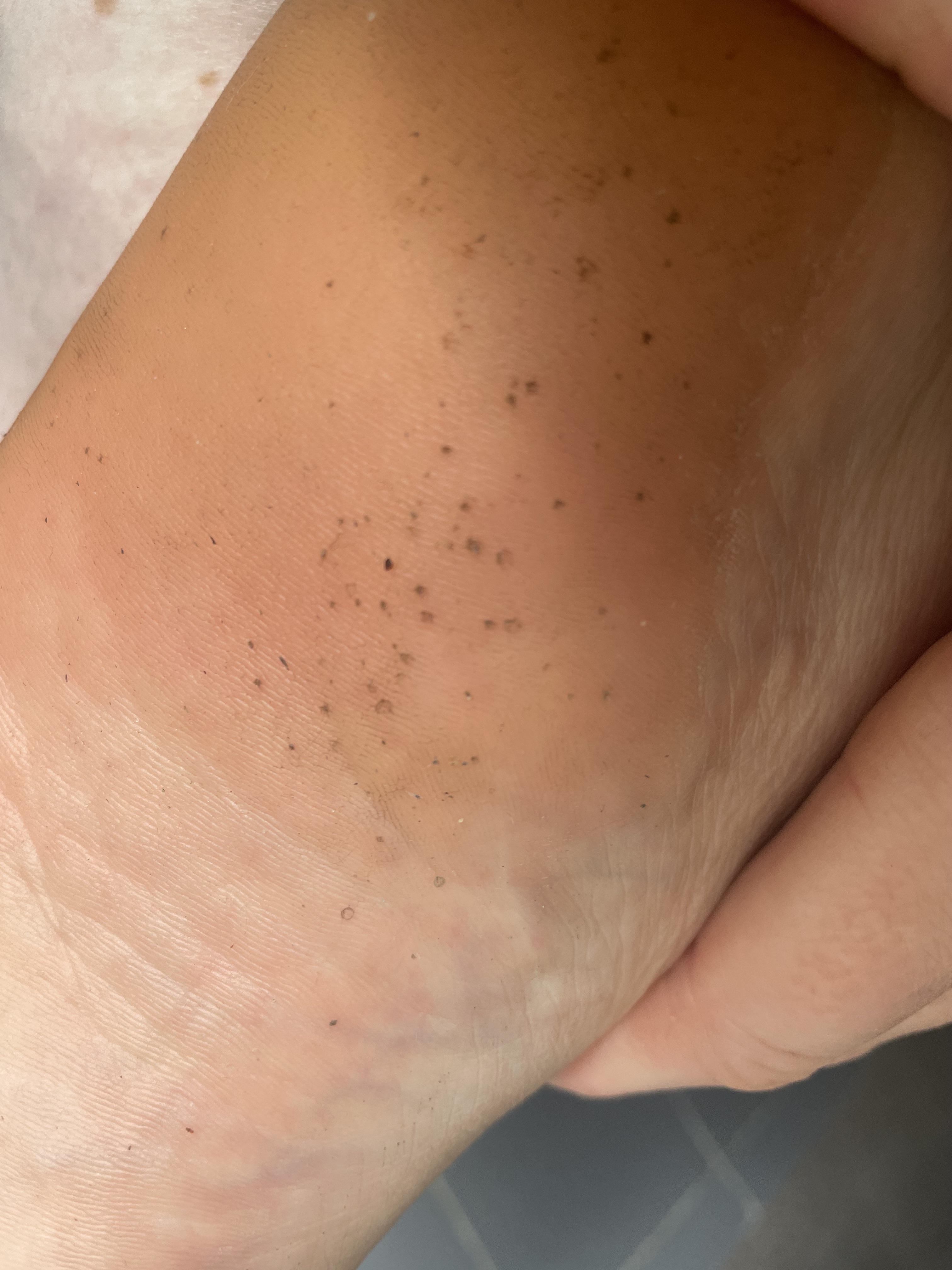 Pitted keratolysis? My 2 year old son has it too but it’s apparently