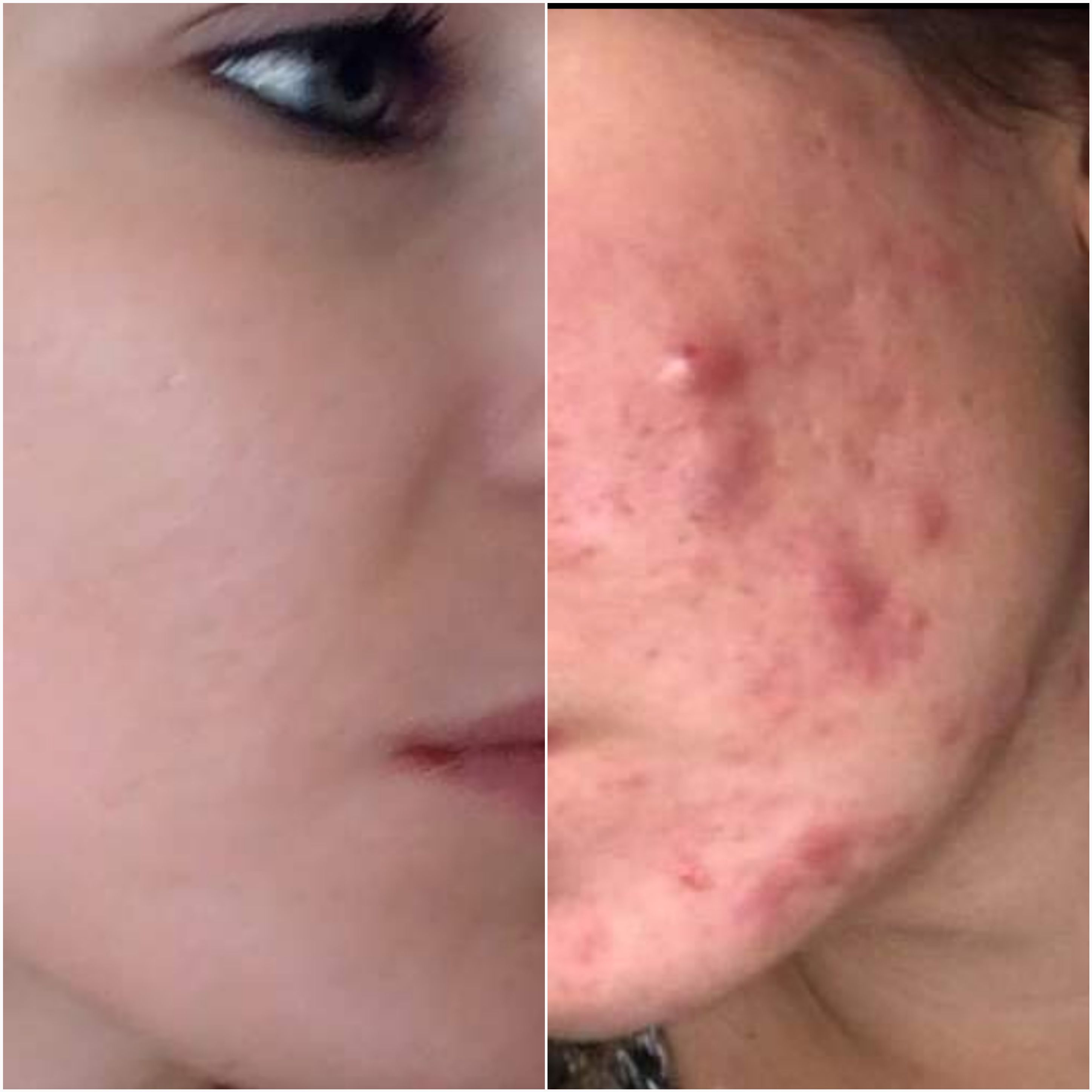 Hi everyone , today iwant to share with you my before and after skin