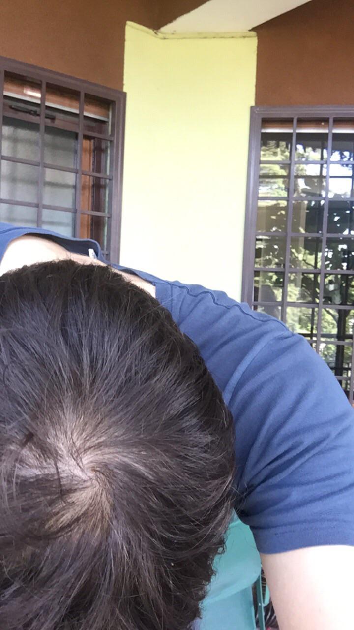 Cowlick or bald spot? malehairadvice