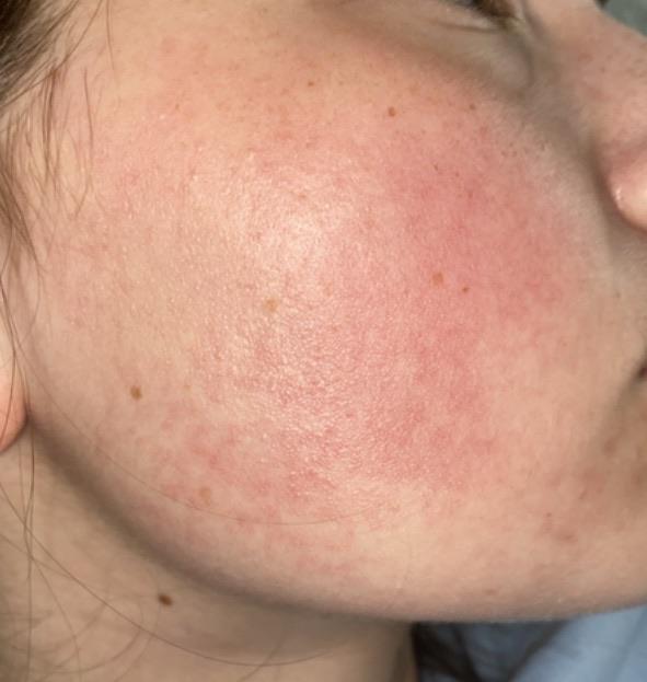 Albums 100+ Pictures Keratosis Pilaris On Face Pictures Excellent