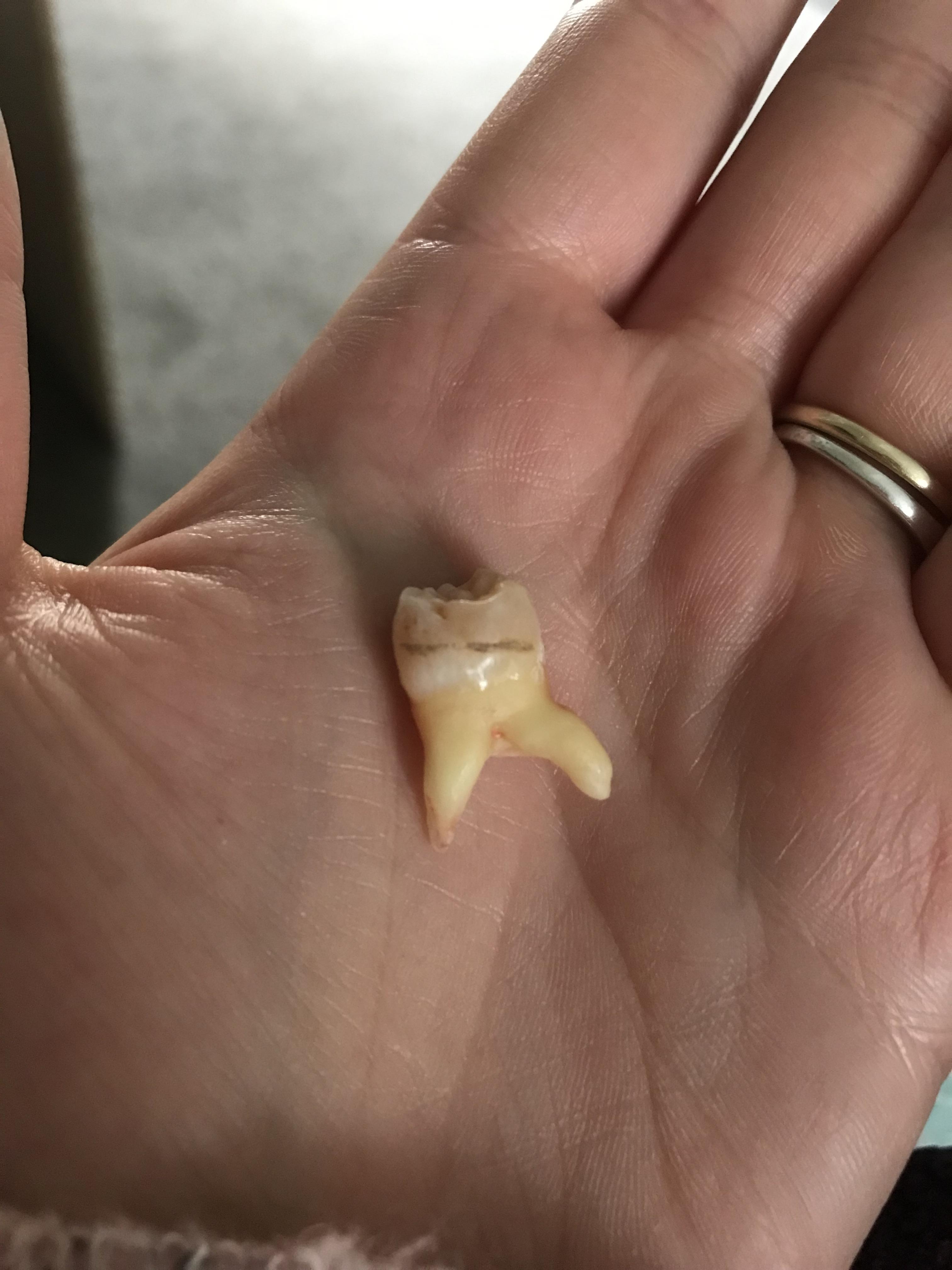 Wisdom tooth looking like it’s off for a walk. pics