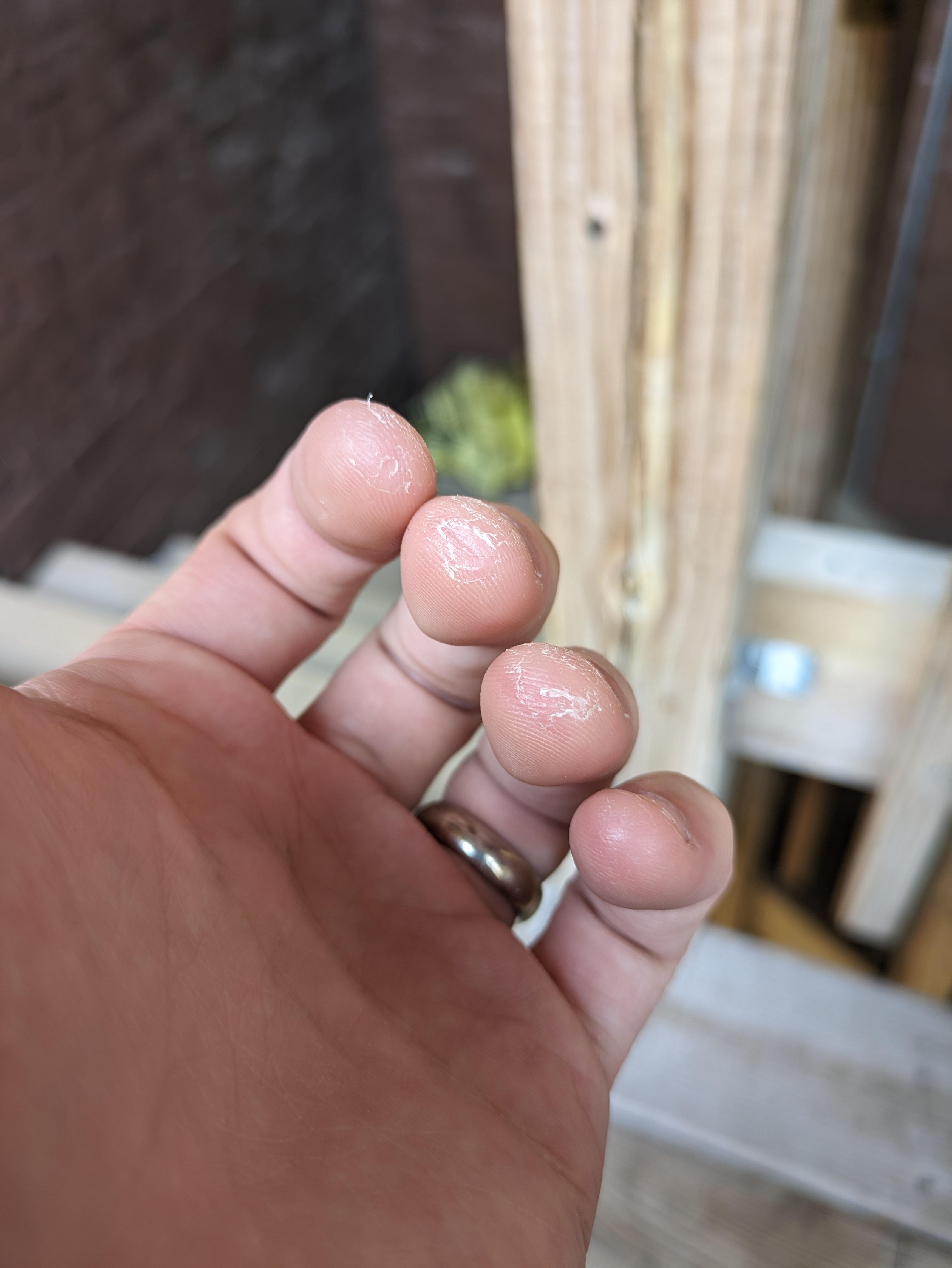 My fingertips are calloused after playing guitar daily for 2 years r