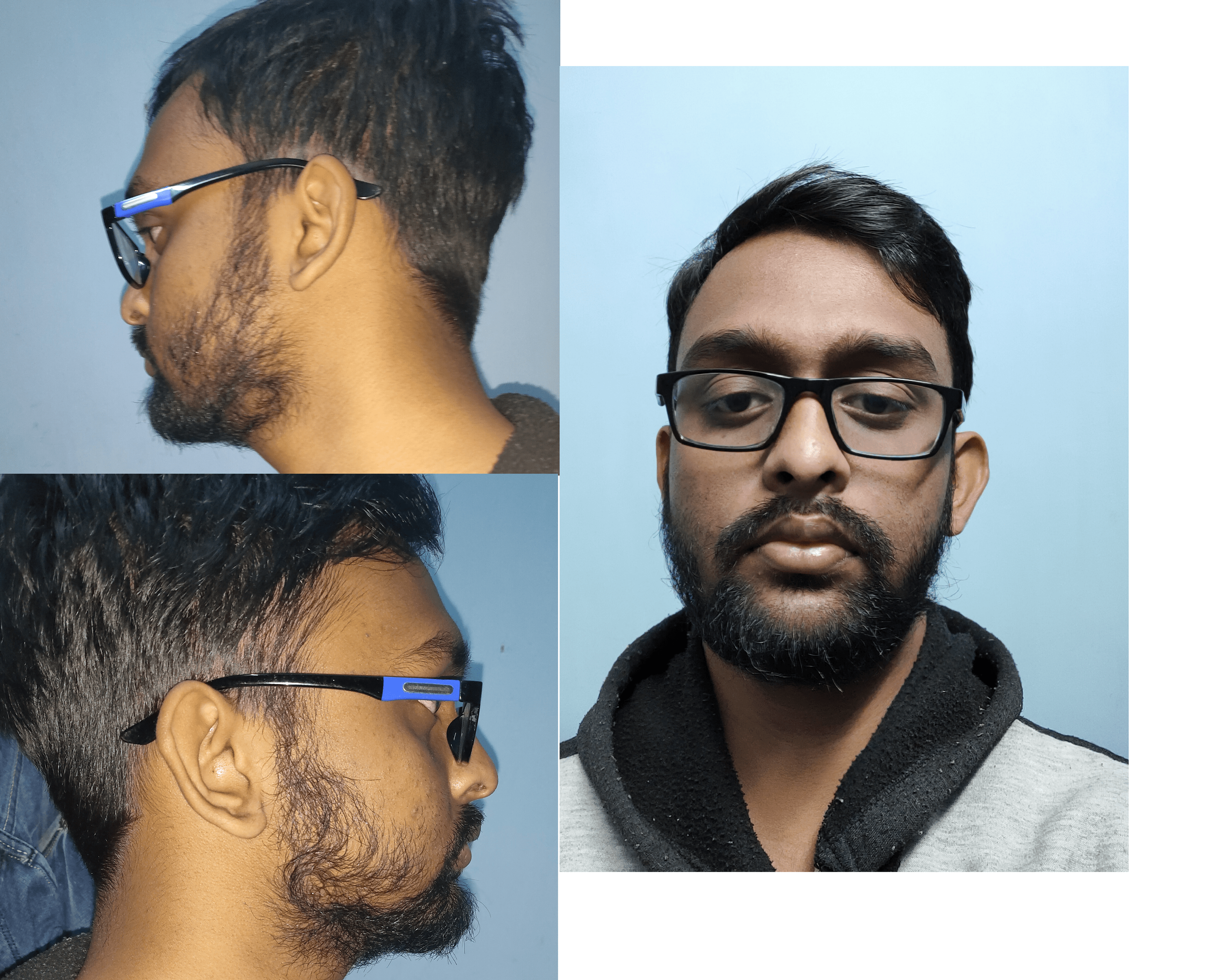 Patchy beard. I used to trim 10mm but recently started to grow. One