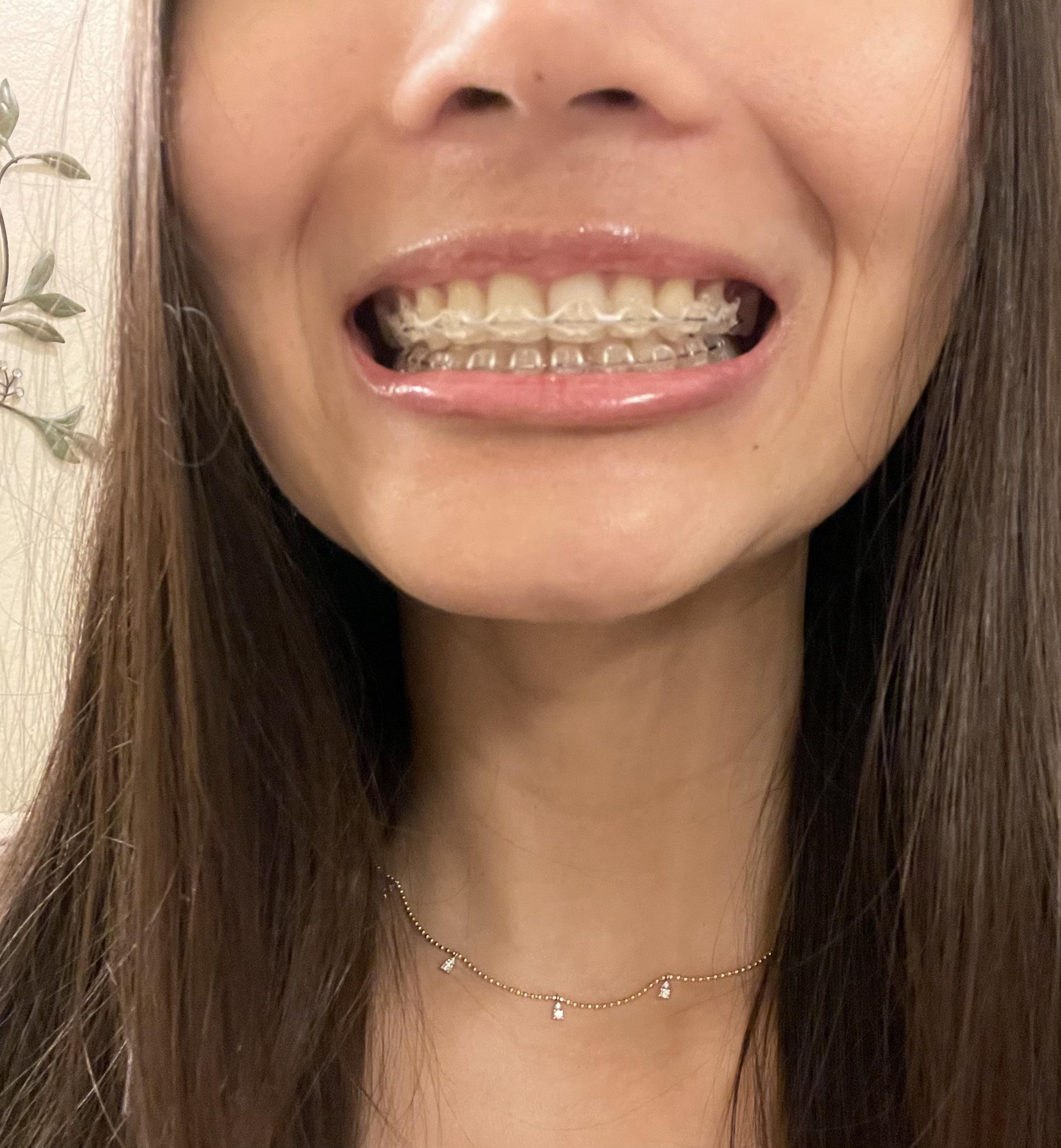 Braces coming off in a month! r/braces