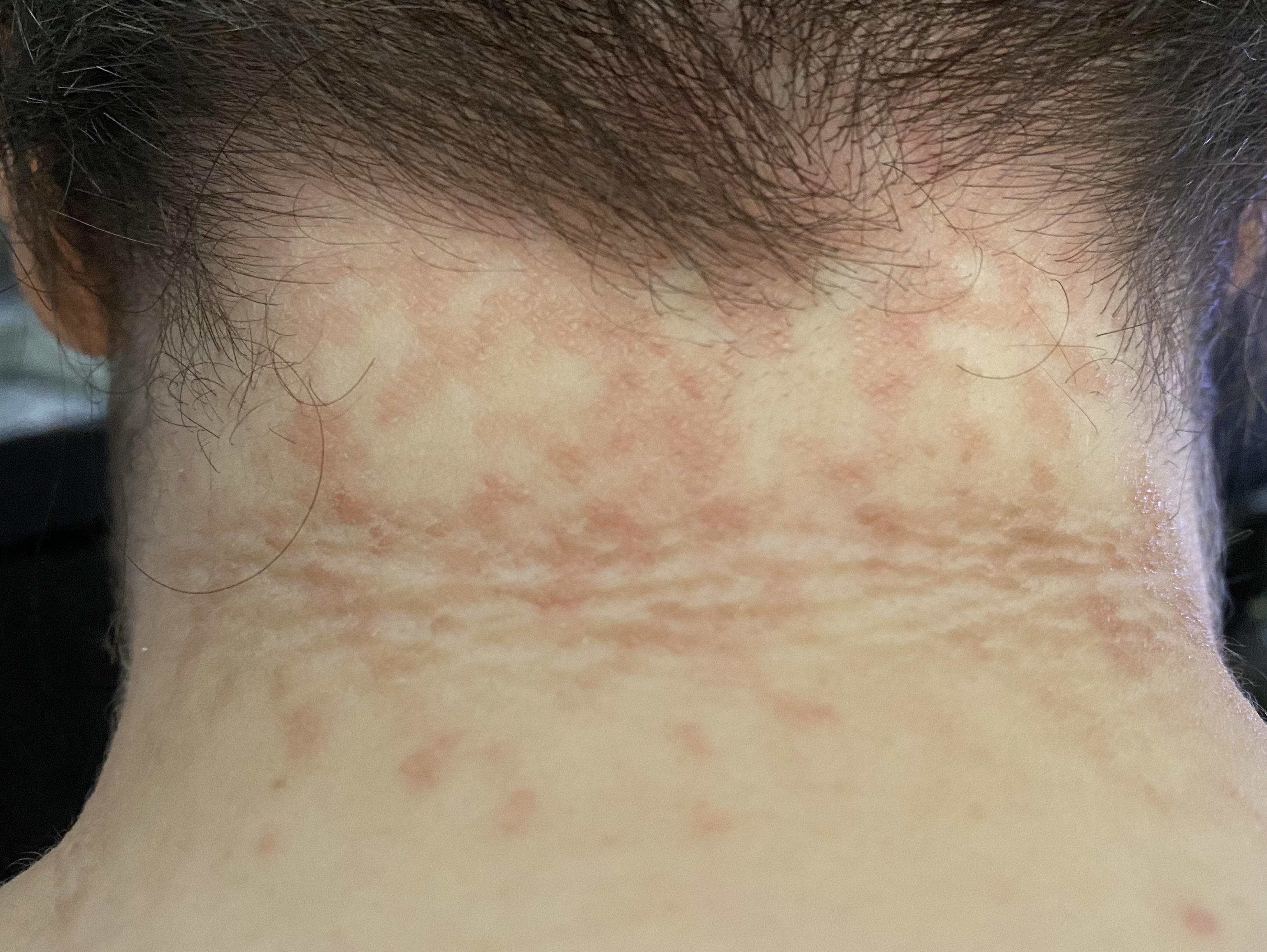 Red rash/fungal infection? on neck and scalp? Head and shoulders and selenium sulfide not