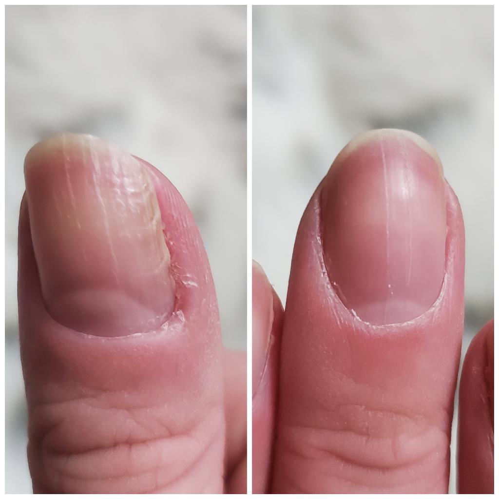 White Lines On Nails
