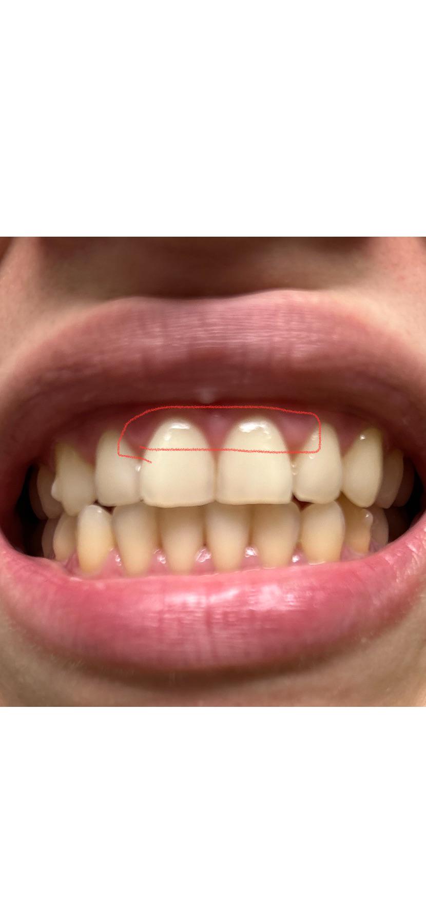 In need of braces but also concerned that i have gum recession on top