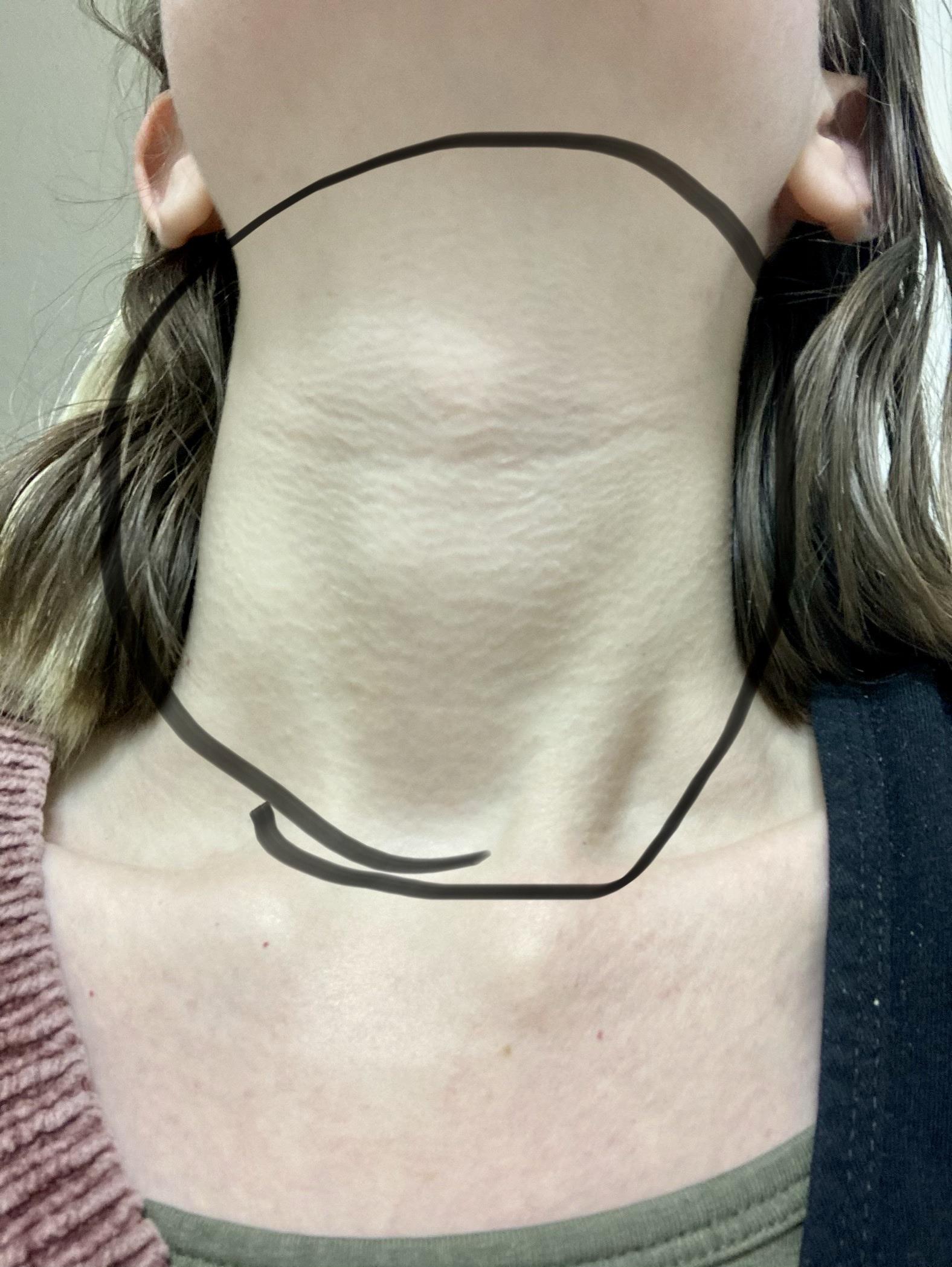 My neck is very tender and swollen on the outside, very sore and dry on