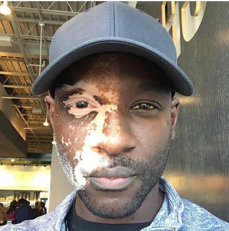 Vitiligo effecting one side of a mans face. interestingasfuck
