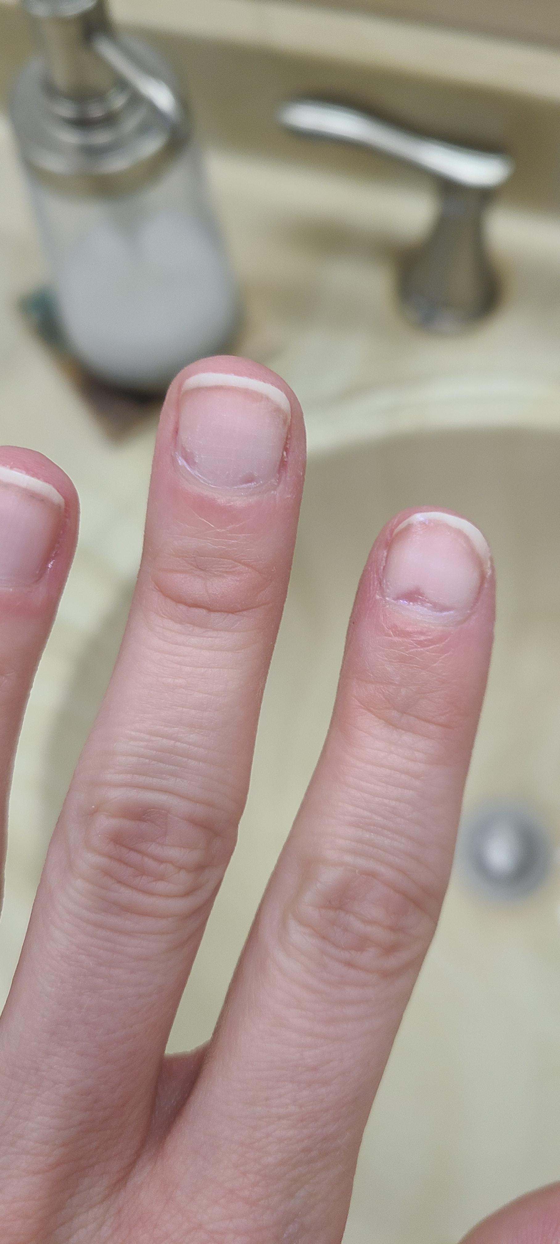 Help! Nail damage, deep gouges from electric file. Advice on what to do as they grow out? Is
