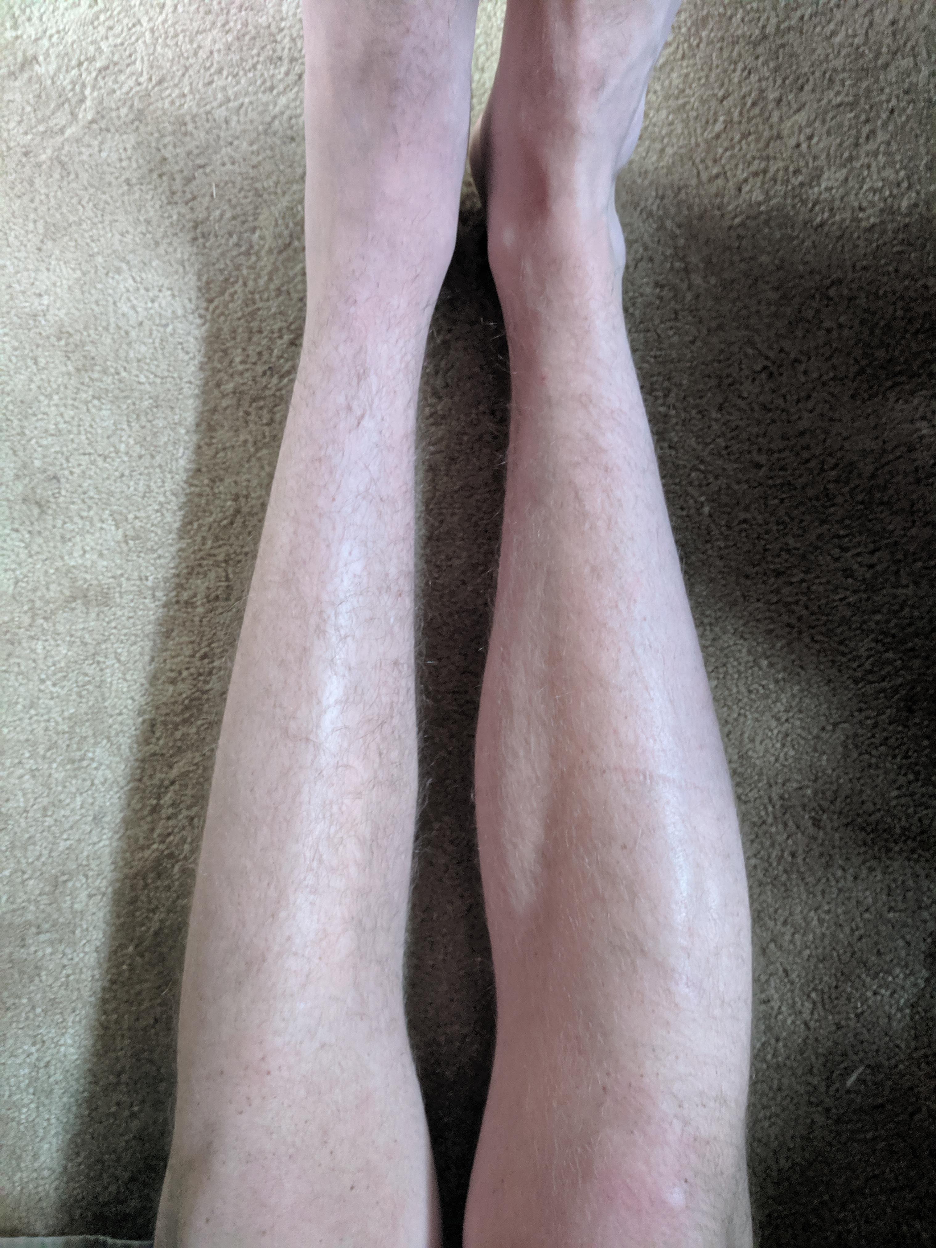The deterioration of my calf muscle after breaking my left heel three months ago (right leg for