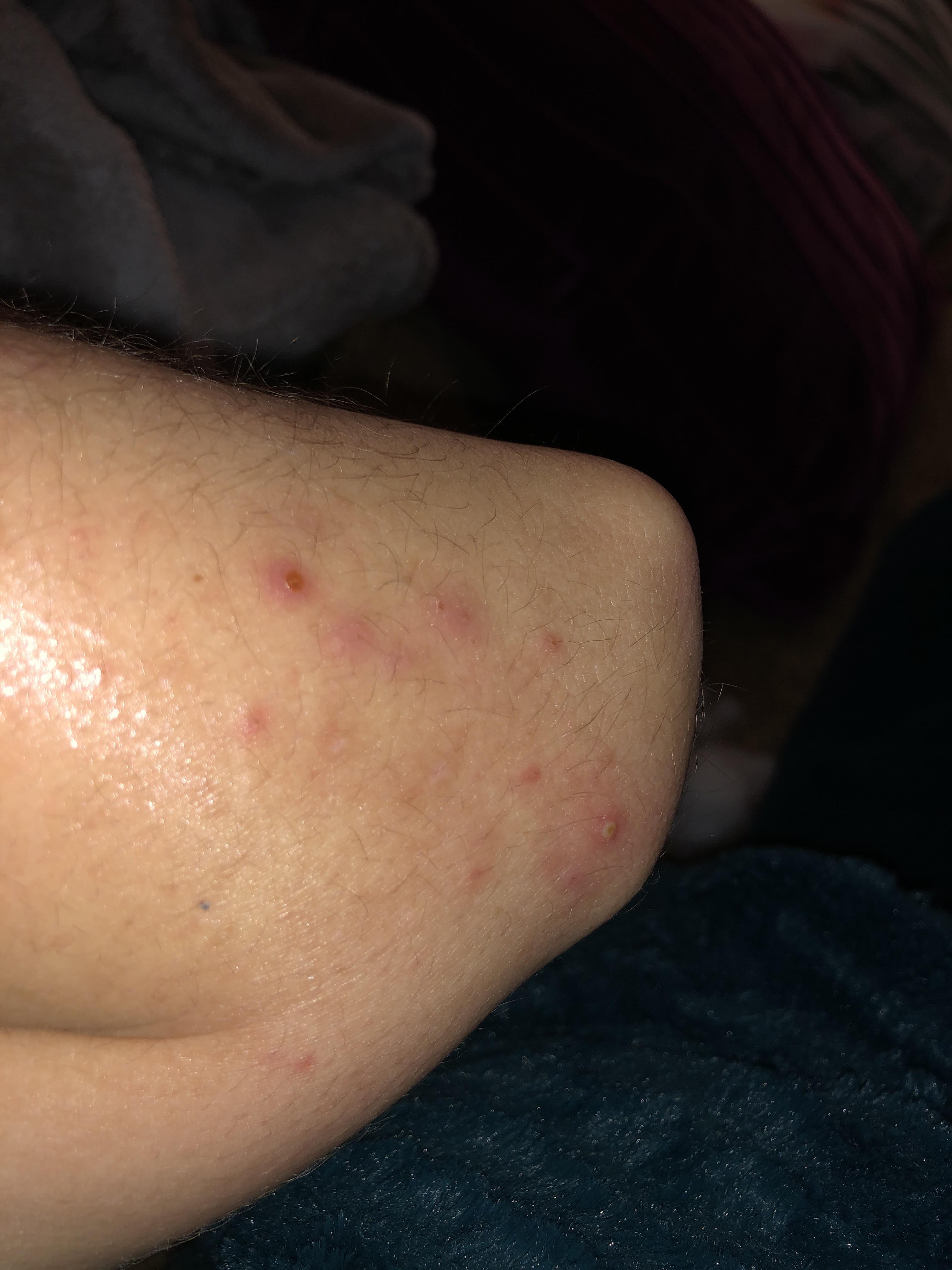 Possible staph infection. Posted pic last night but has gotten worse