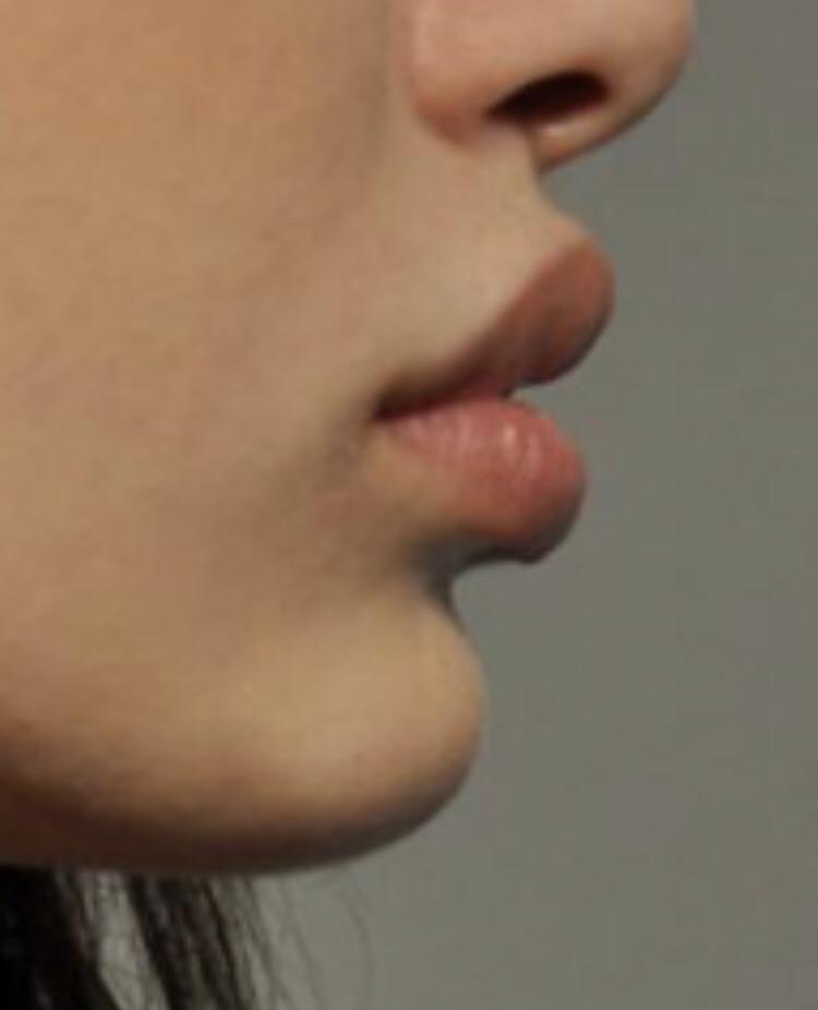What causes the philtrum to stick out and how do I achieve that look