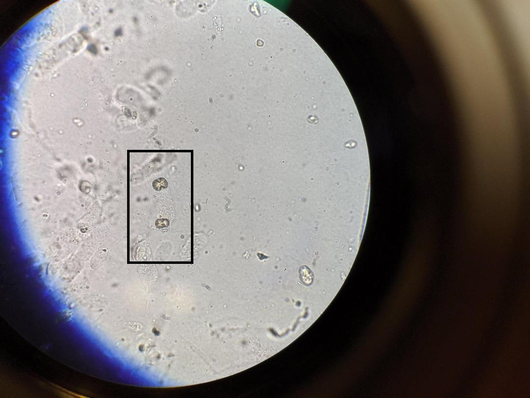 Unknown Urine Crystal in Urine Sediment with pH of 5.5. Very rare