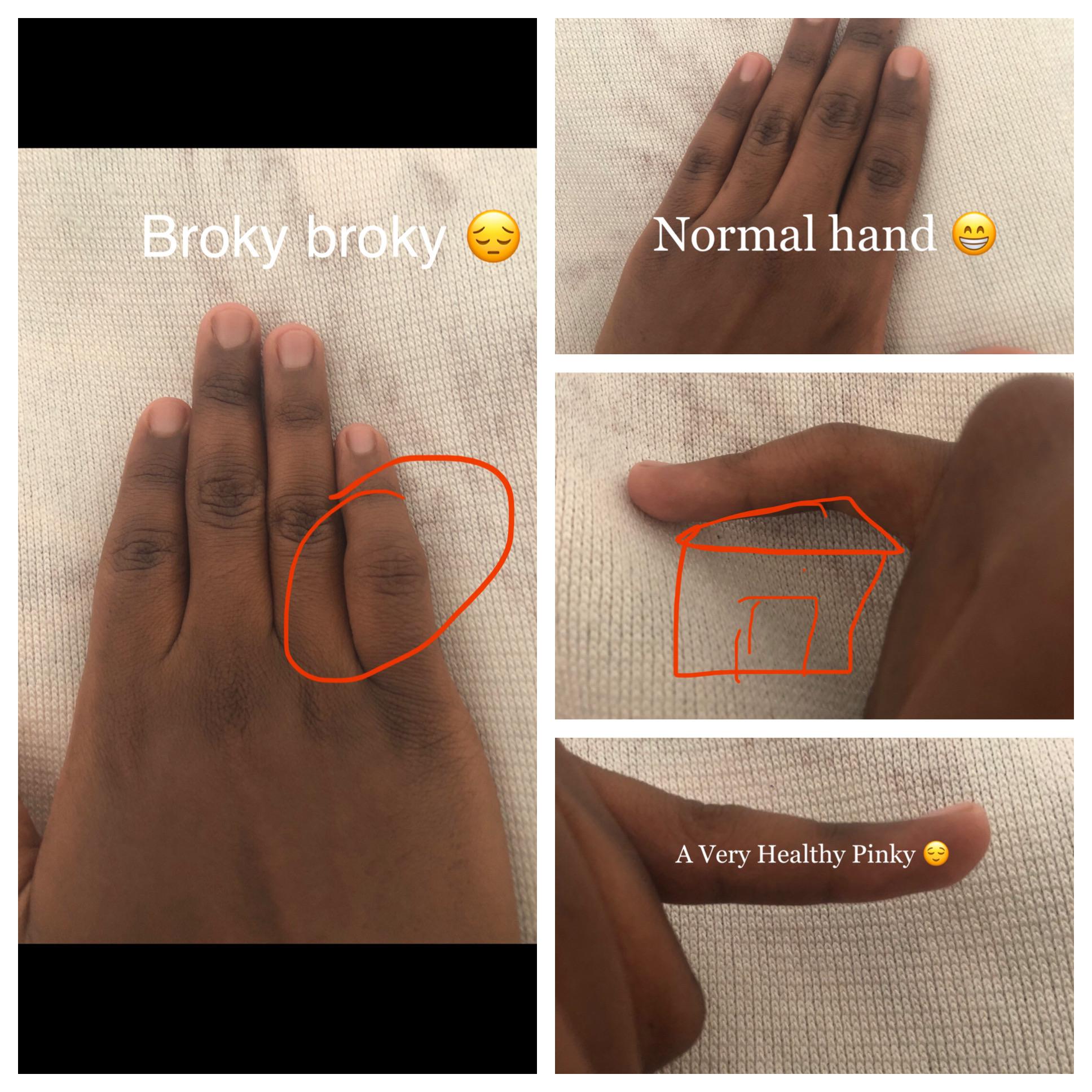 Over a year since I Dislocated My Pinky Finger How do I make it straight and less fat? r