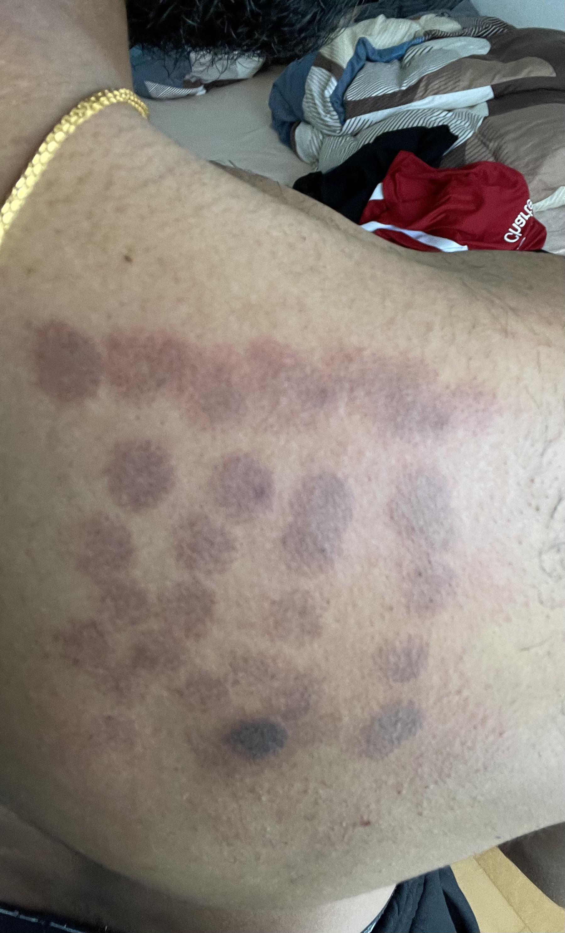 First Alexandrite Hair Removal r/LaserHairRemoval