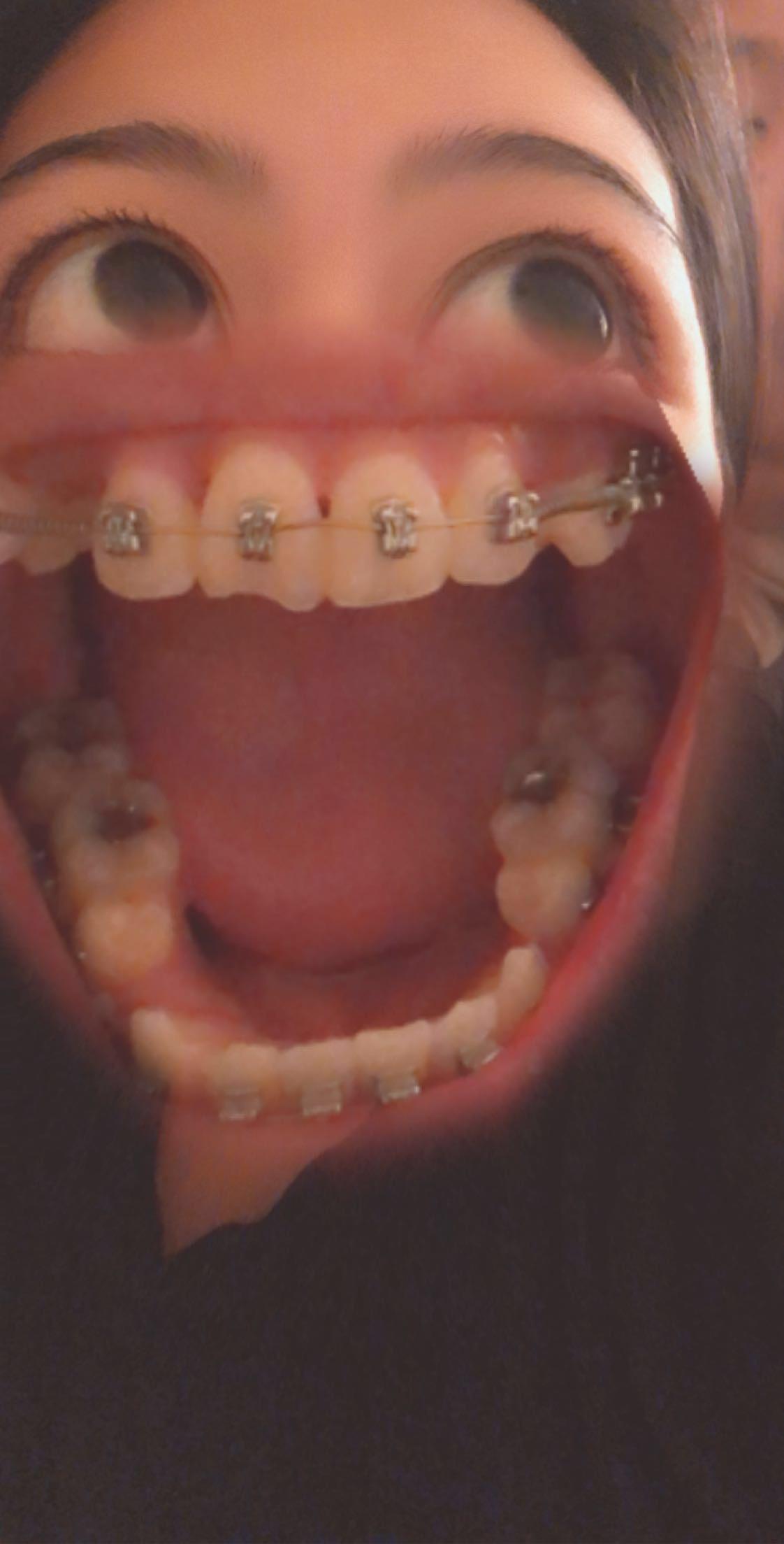 Only had my braces for a couple months. But is it normal that my molars