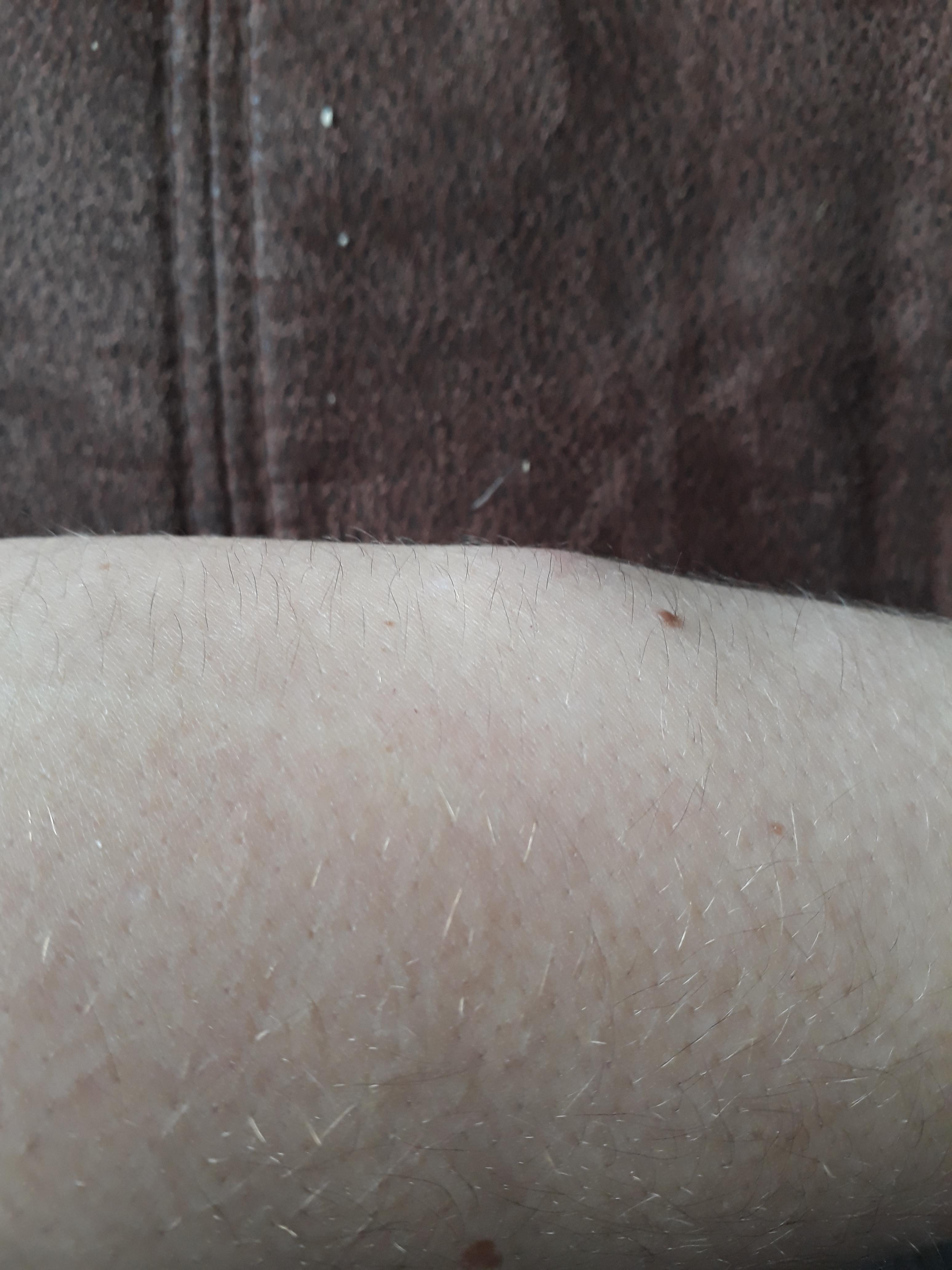 Theres a lump in me arm, I gave it a squeeze and I felt it pop (ouch