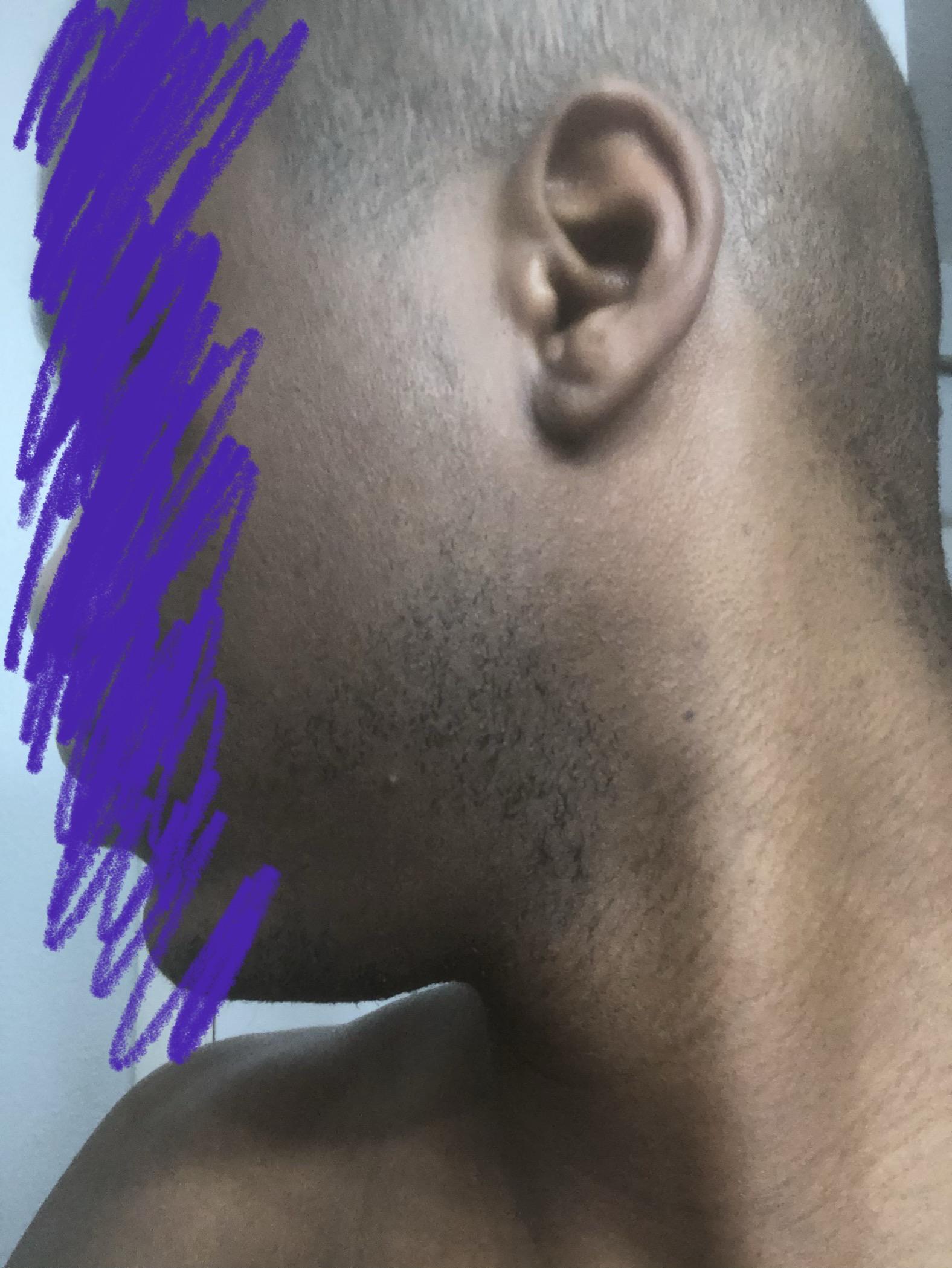 How do I get the vellus hairs to grow in patchy spots? Progress so far