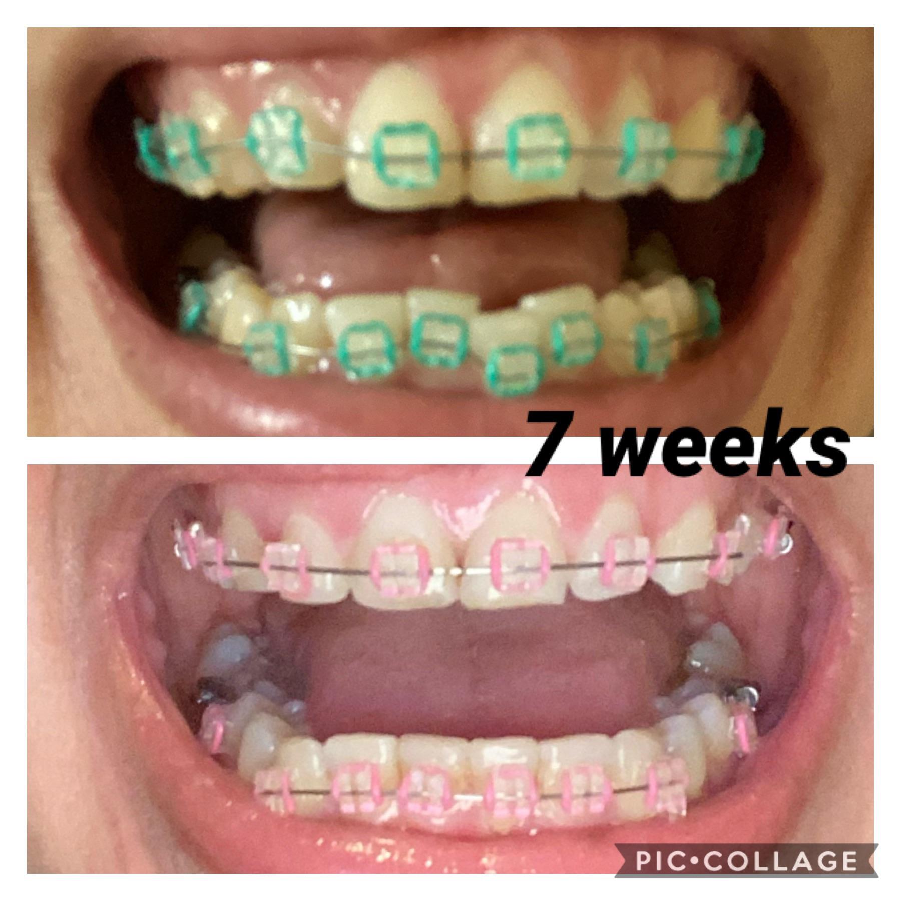 First tightening, any tips for extractions? I have some coming up in 2