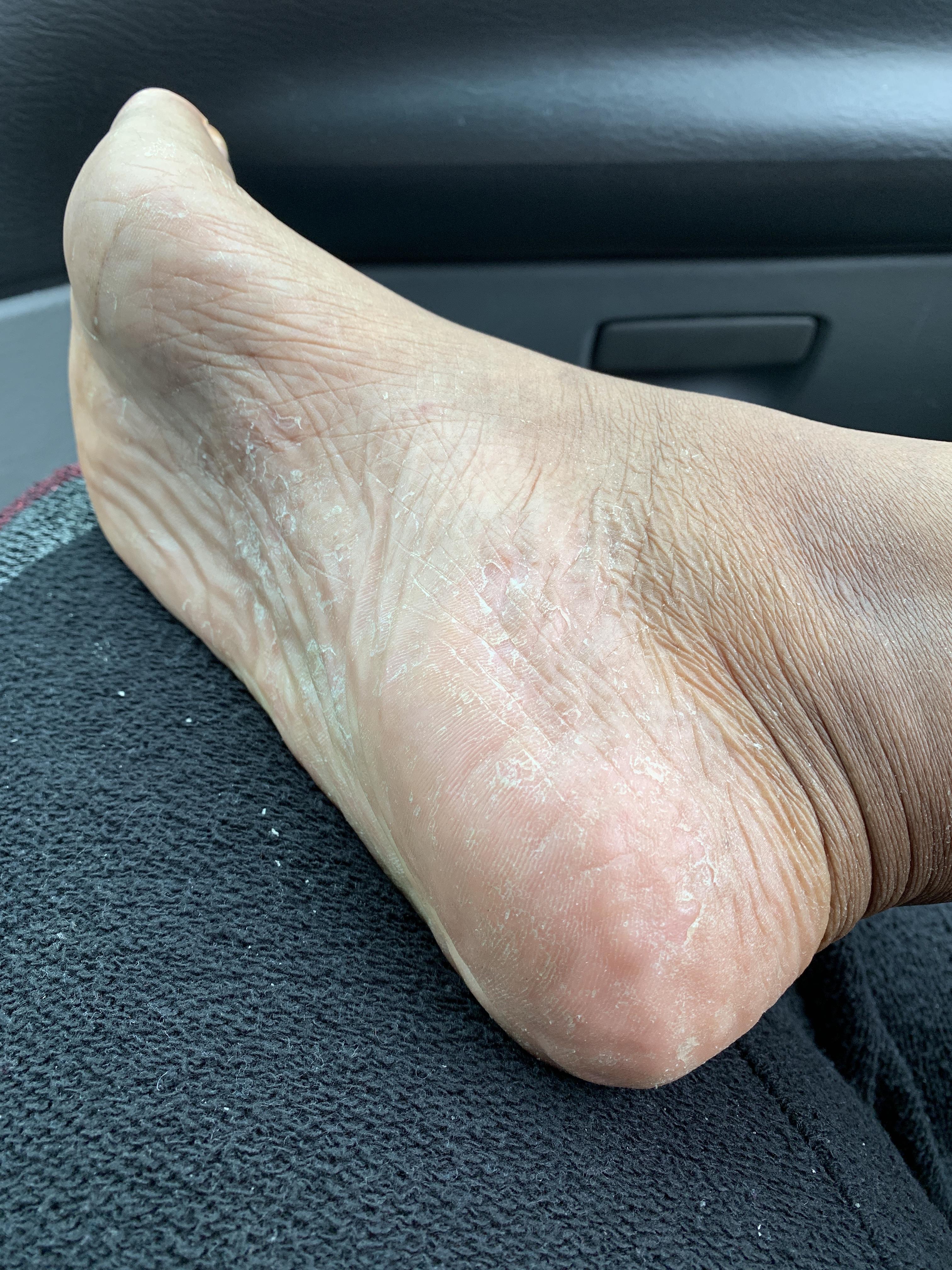 TMI Really dry, itchy feet?? I have no clue why my feet have been so itchy, dry, with like