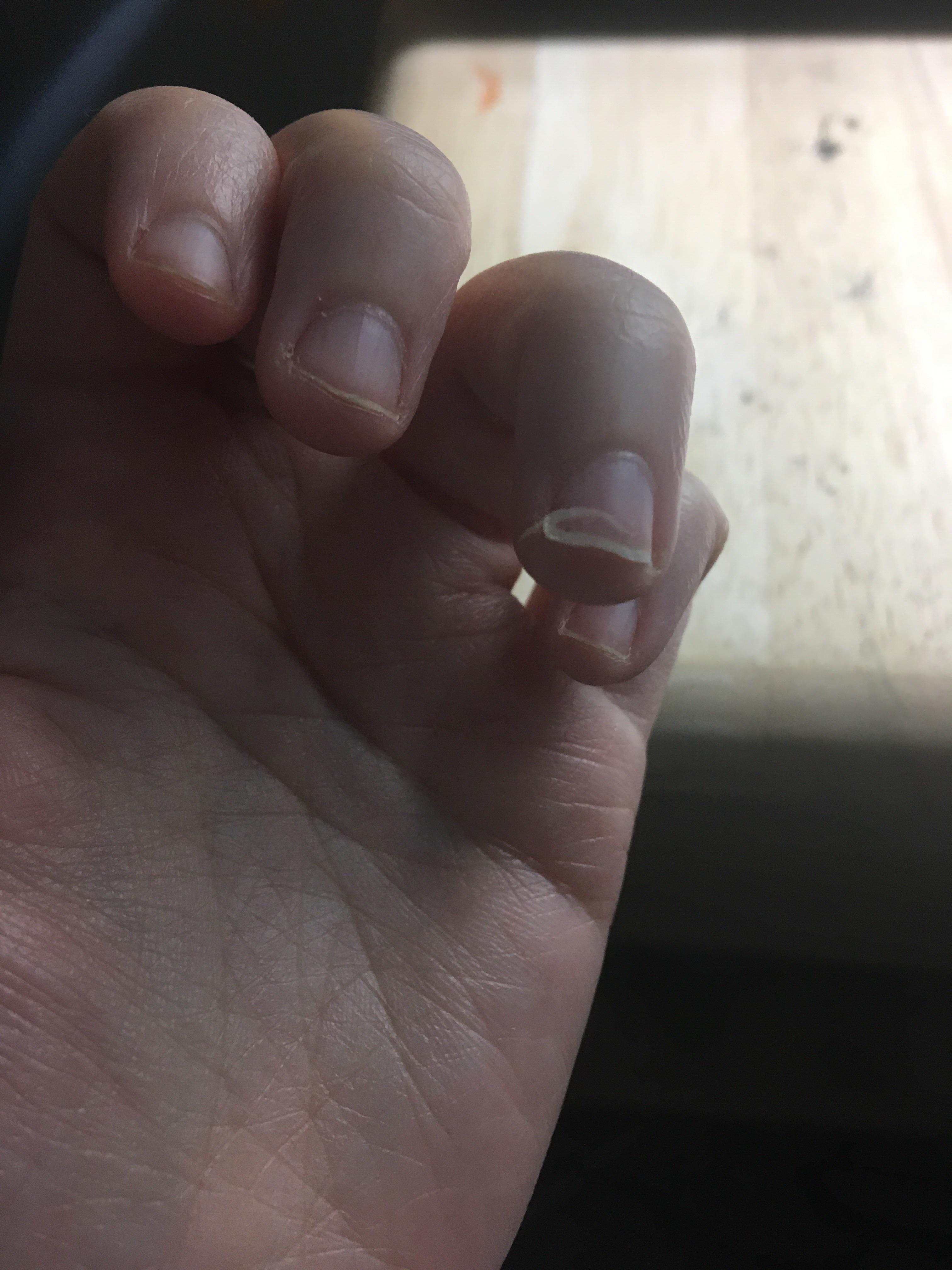 Accidental knife cut abt a week & 1/2 ago. What should I do? r/Nails