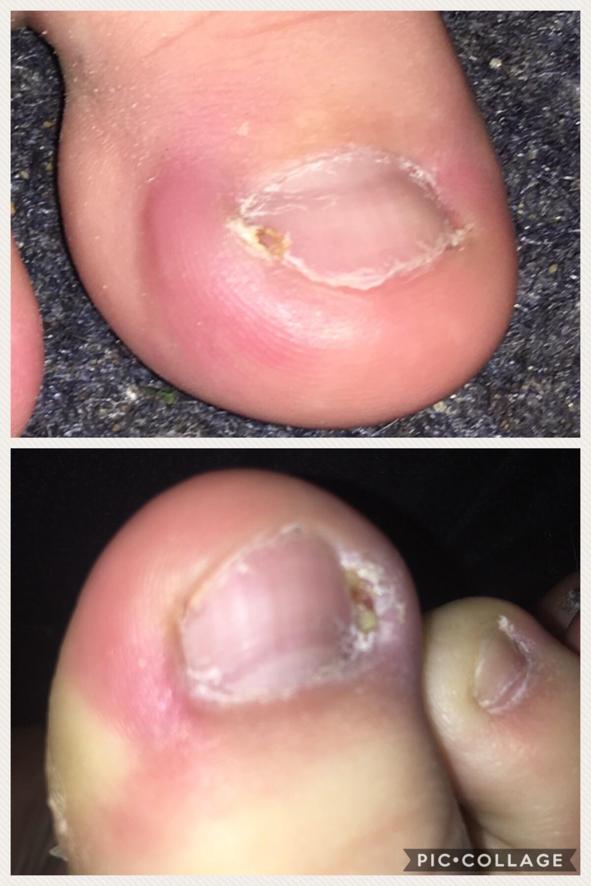 ingrown nail only seems to be getting worse. the skin under the area