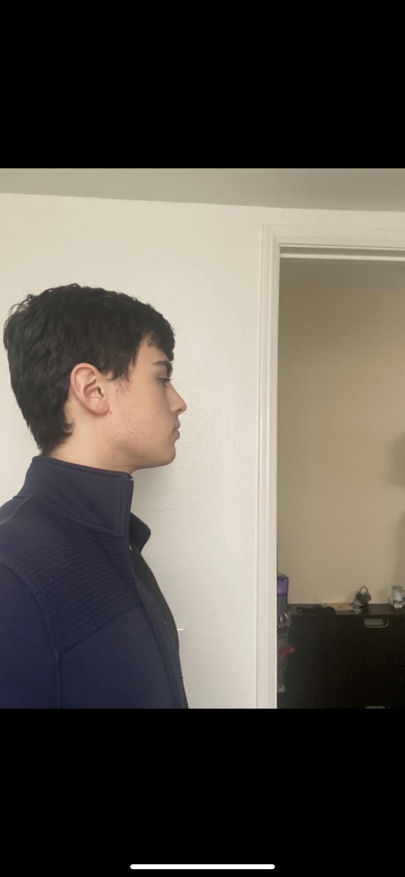 Thumb pulling what are the side effects (headache?) and possible