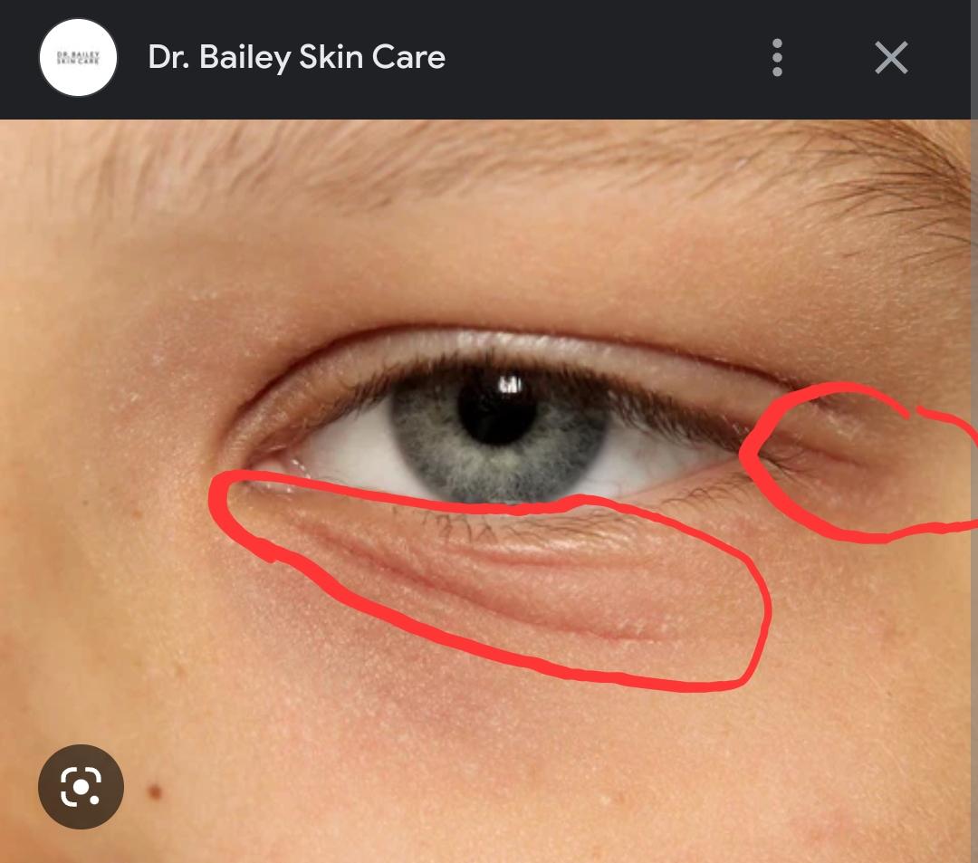 Eye Irritation in those areas, could it be Dermatitis or an allergy