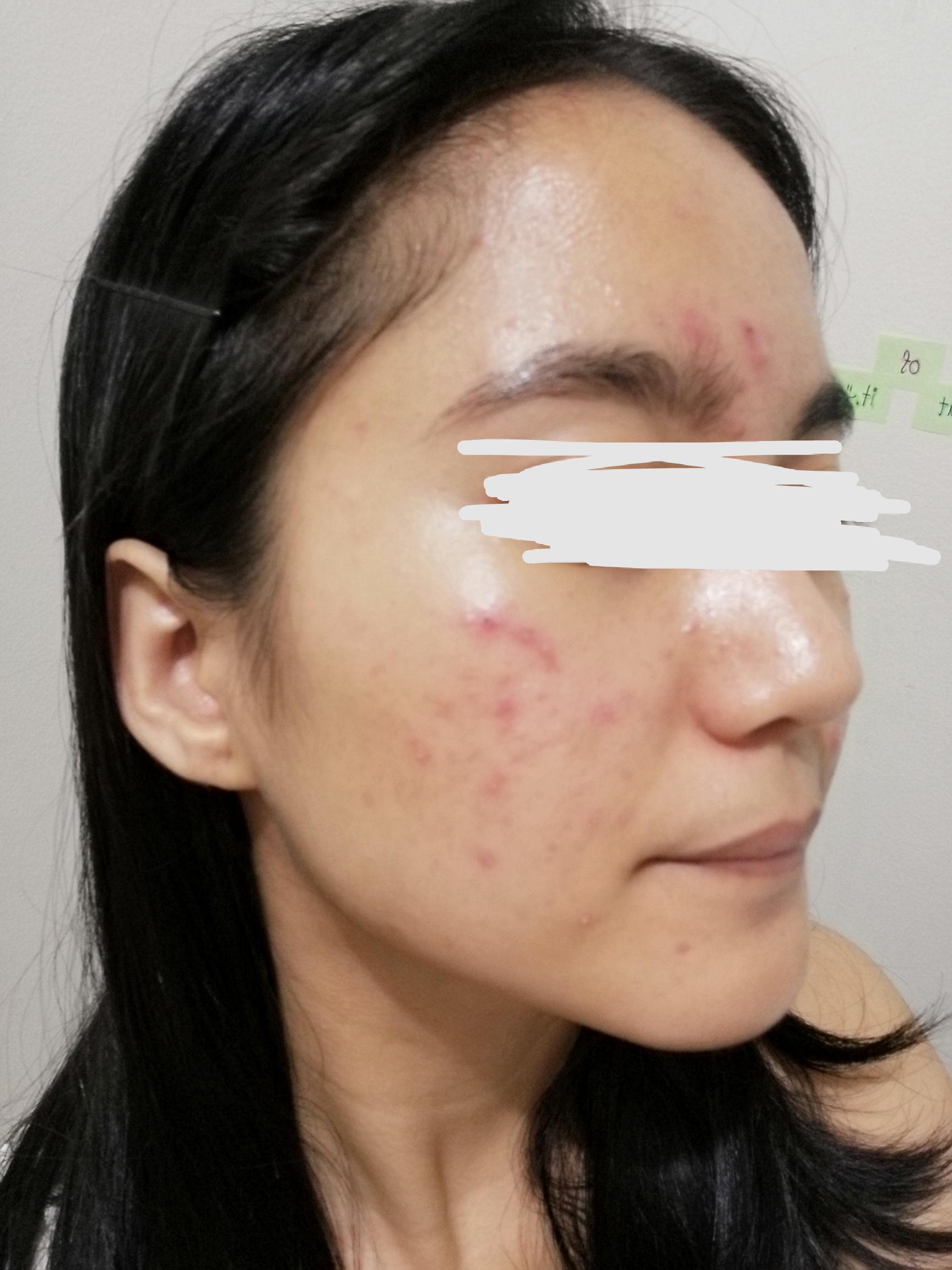 Can The Ordinary azelaic acid 10 cure help with this type of acne and hyperpigmentation from my