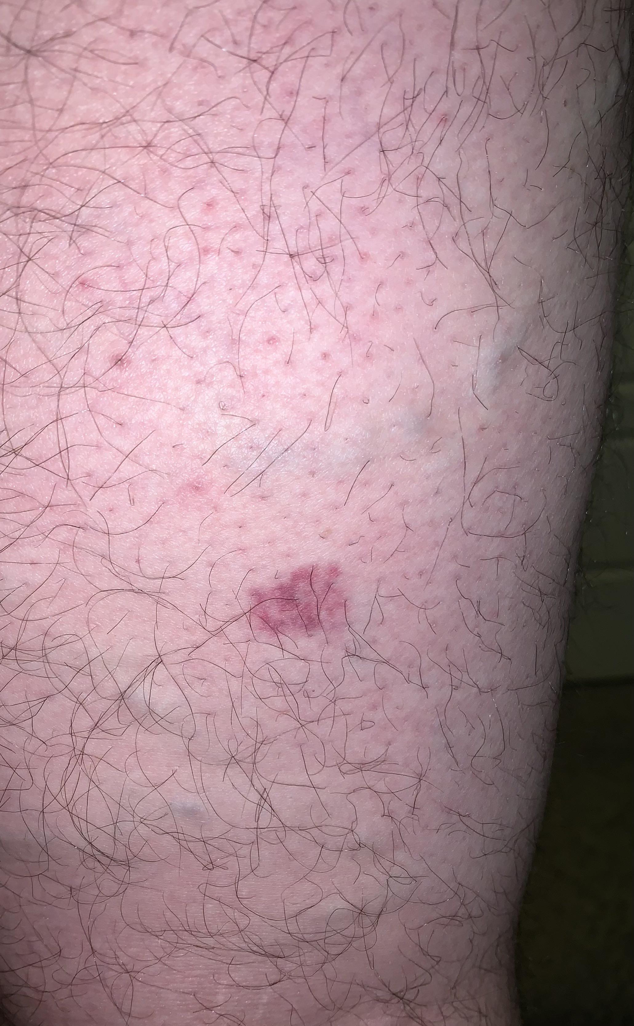 Please talk my anxiety off a cliff. Late 20s. Male. I have bad varicose