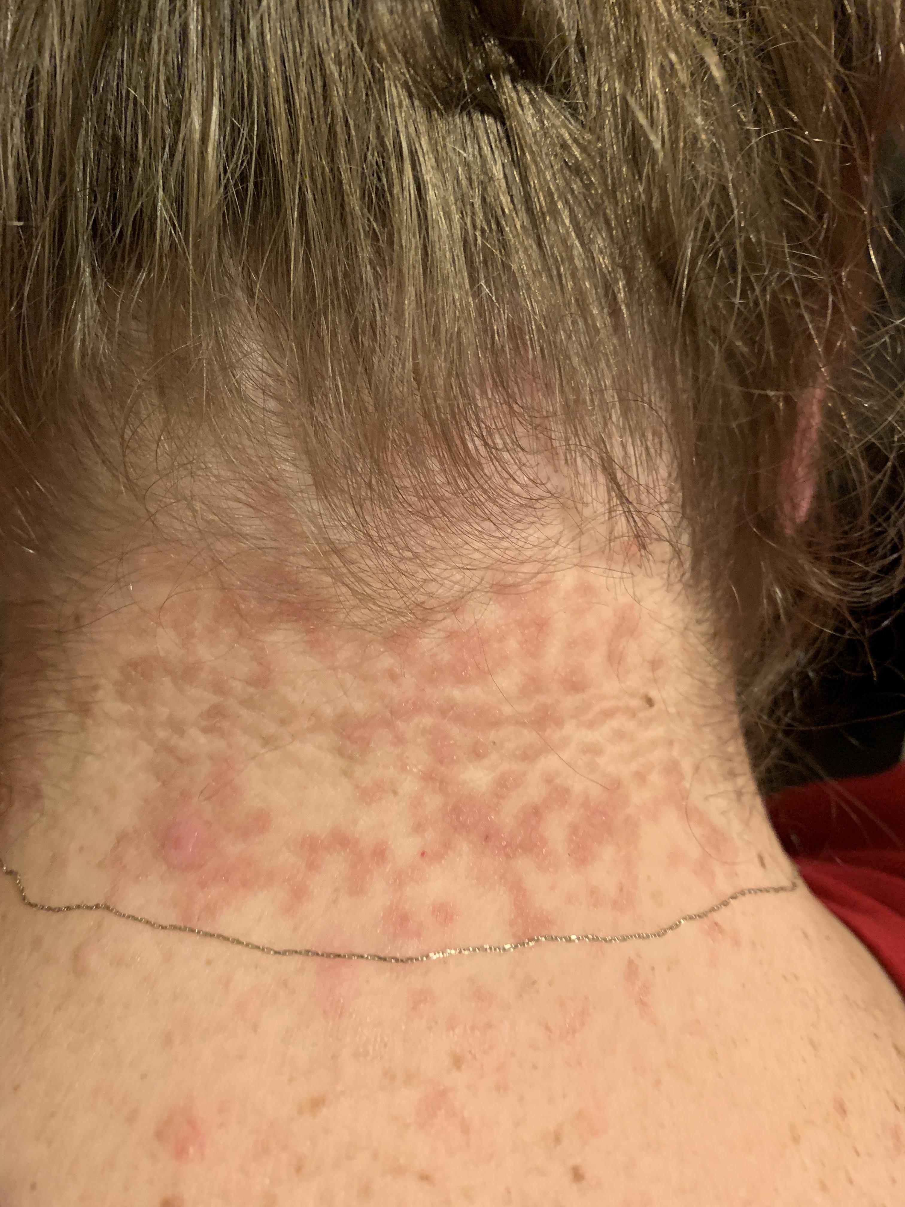 Why Do I Have A Random Red Rash On My Neck Printable vrogue.co