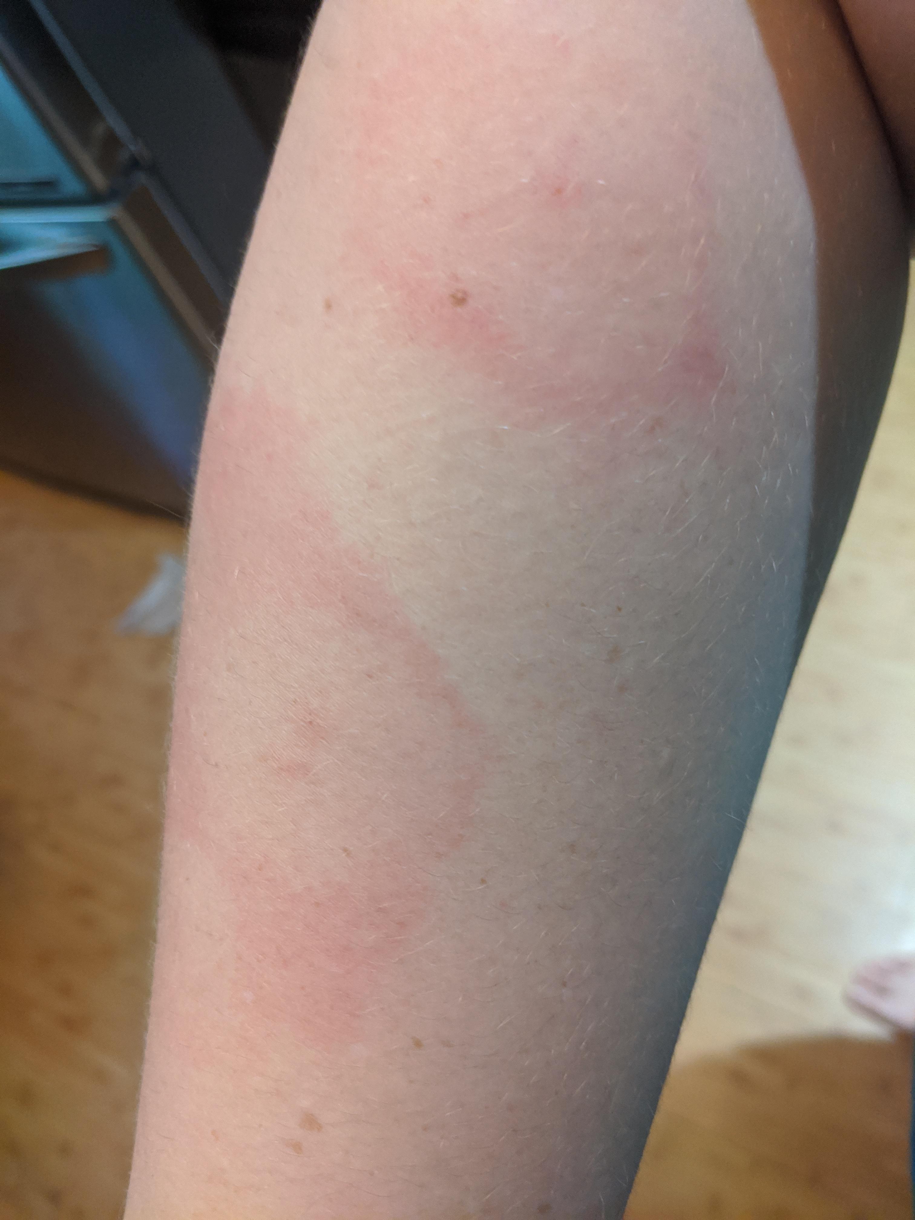 Mosquito bite allergy or something else...??? r/bugbites