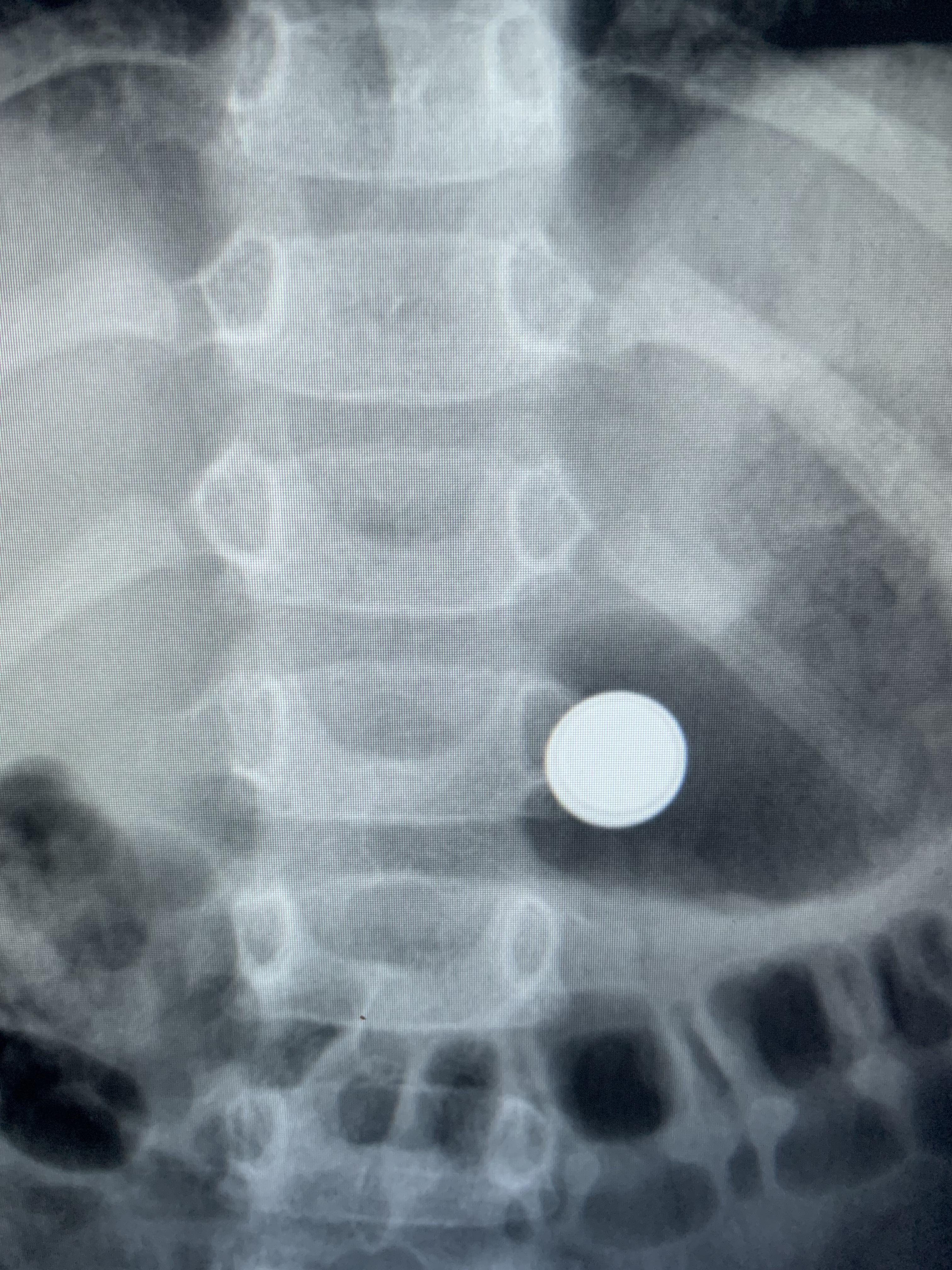 Ingested Button Battery (contrast with coin from prior post) r/Radiology