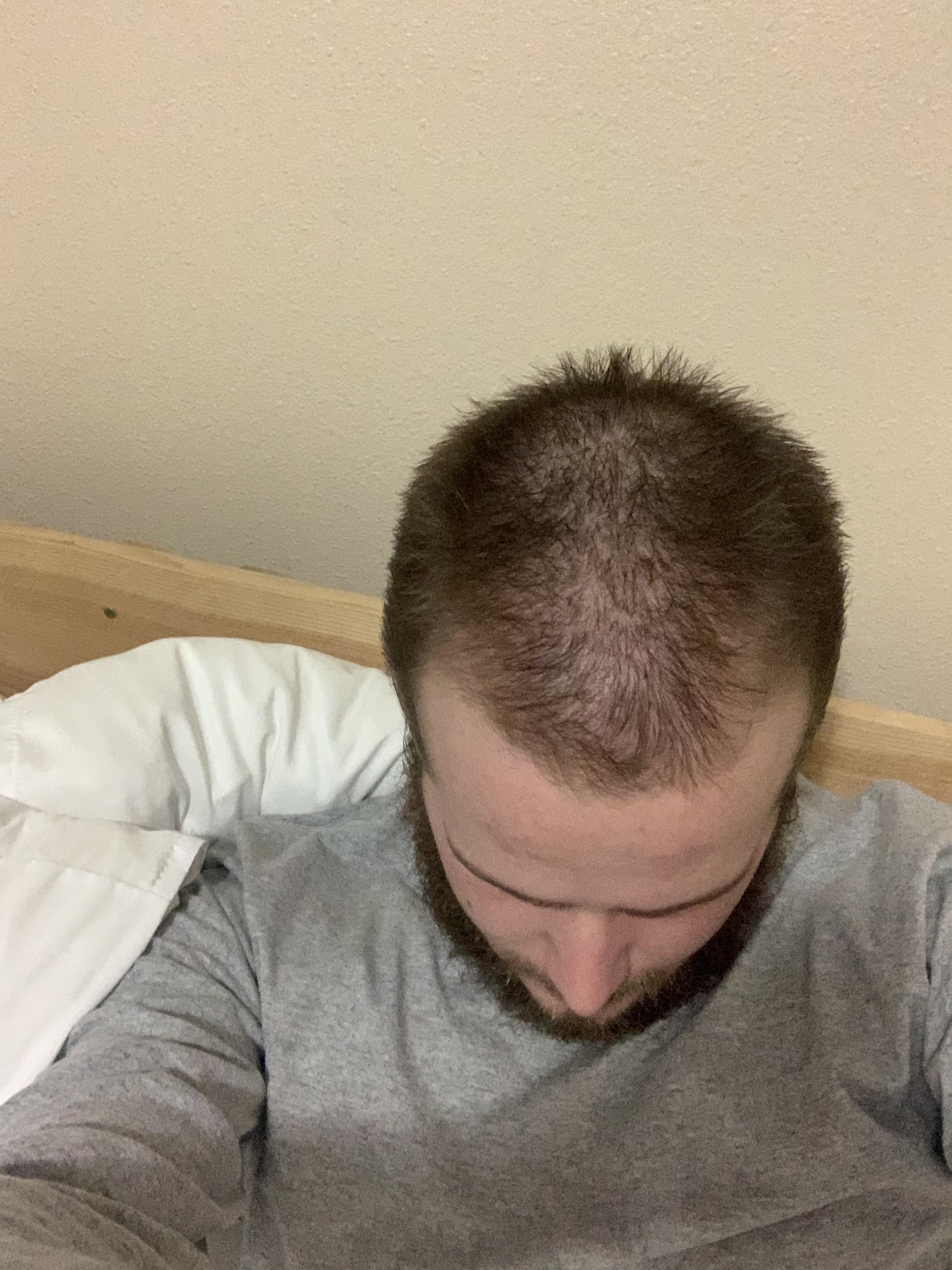 I'm 20 years old how bad is my hair loss? r/bald